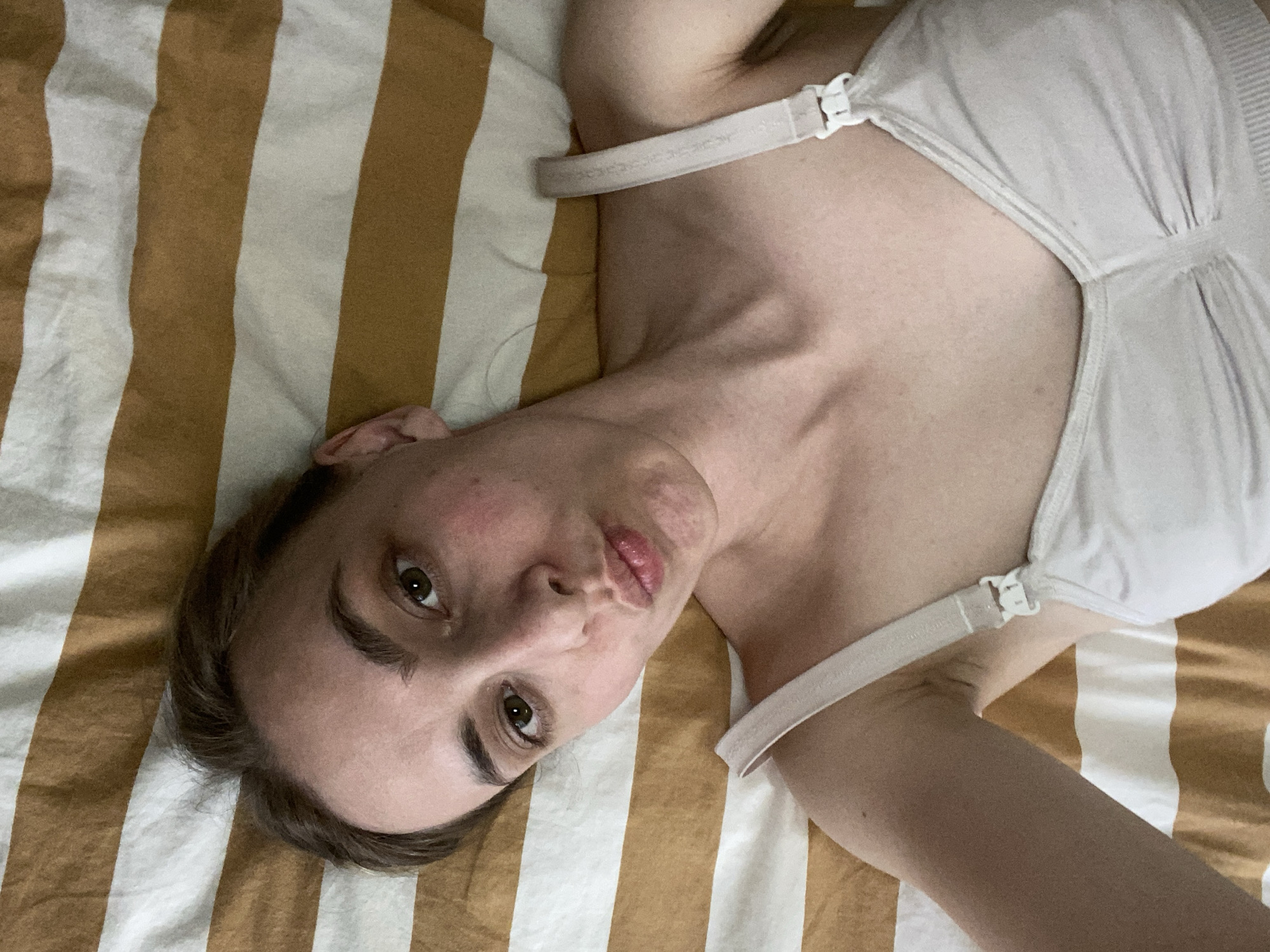 A pale-skinned woman lies on a striped, gold and white bedsheet. She is wearing a white bra-type top with thin straps. Her head is turned to the side, her gaze directed at the camera with slightly pursed lips. Her brown hair is pulled back, and her skin has some red discoloration, primarily around her cheeks and jawline.
There is no information in the image that indicates this photo was taken in Chaikovsky, Russia, or any other specific location.