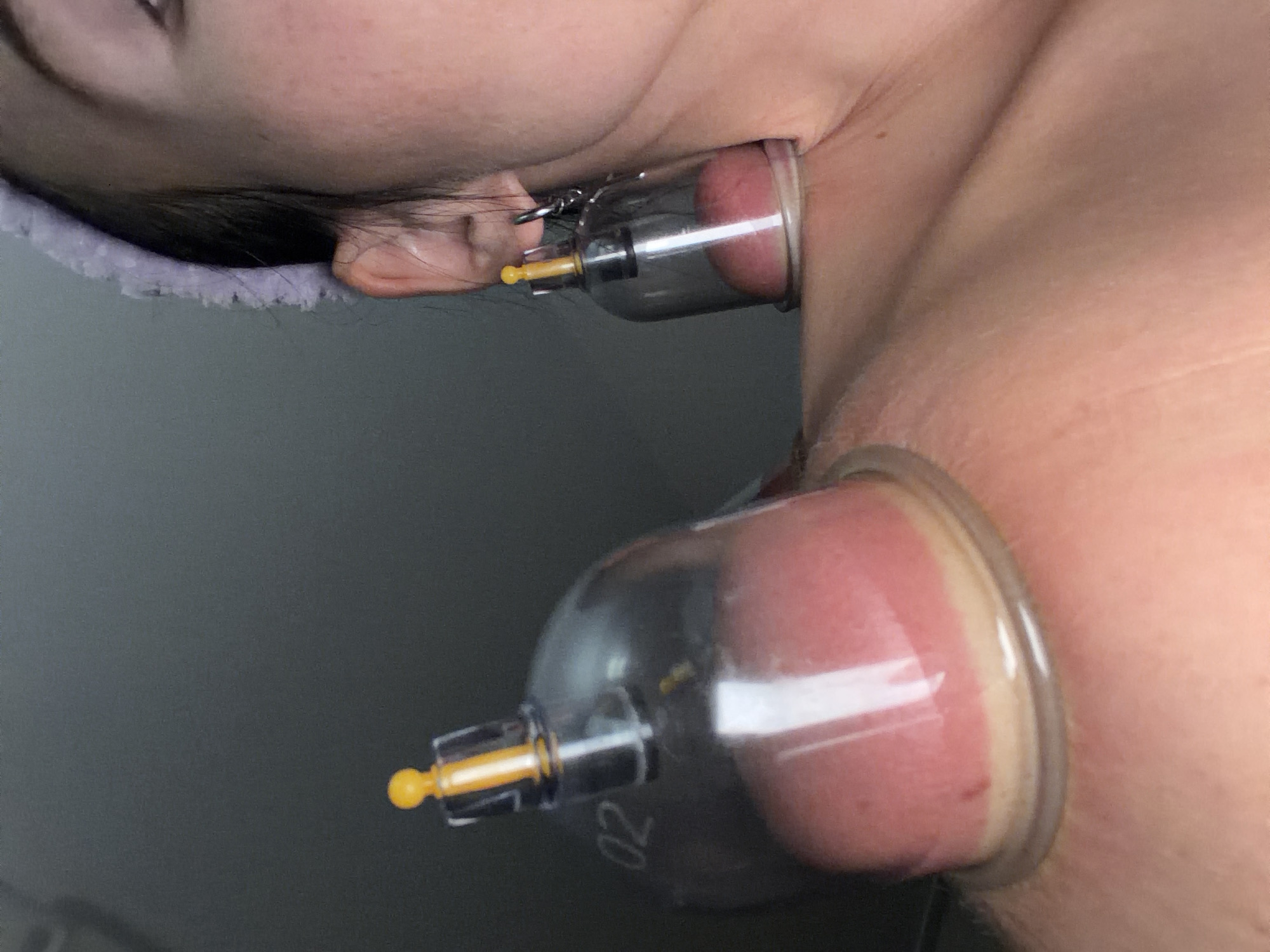 A close-up shot depicts a person with two cupping devices attached to their neck and shoulder. The cups are clear plastic, with yellow plungers and attached to the skin, causing localized redness and swelling. The person has a headband visible at the top of the frame near their ear. The background is a plain gray surface. There is no indication of the location being Saint Petersburg, Russia.