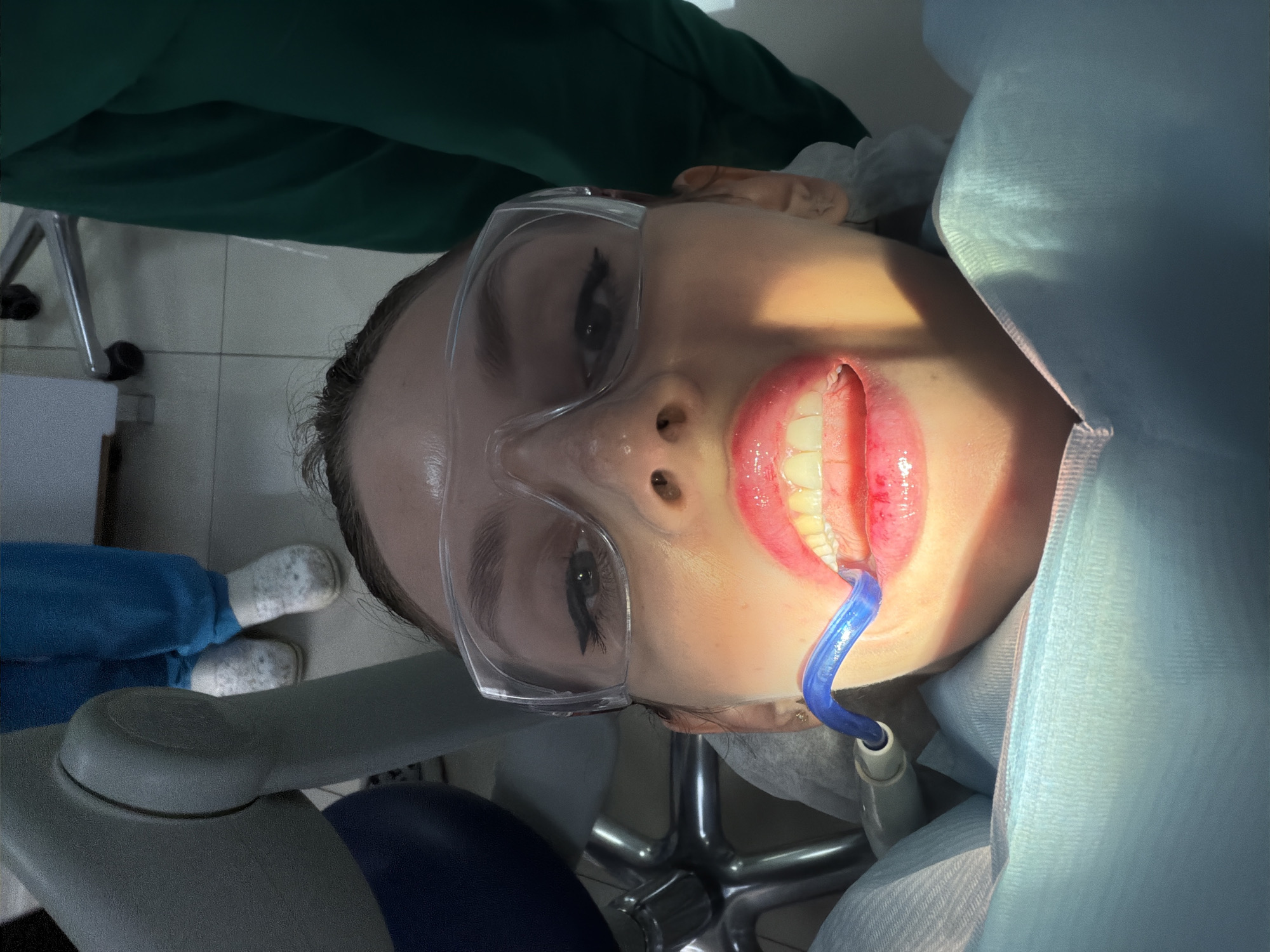 The image shows a person in a dental chair, possibly in Budva, Montenegro, though this cannot be confirmed from the image alone. The person wears protective eyewear and has a blue dental suction device in their mouth. The dental chair and surrounding equipment are visible. A healthcare professional in scrubs is partially visible. The focus is on the person's face and the dental procedure taking place.