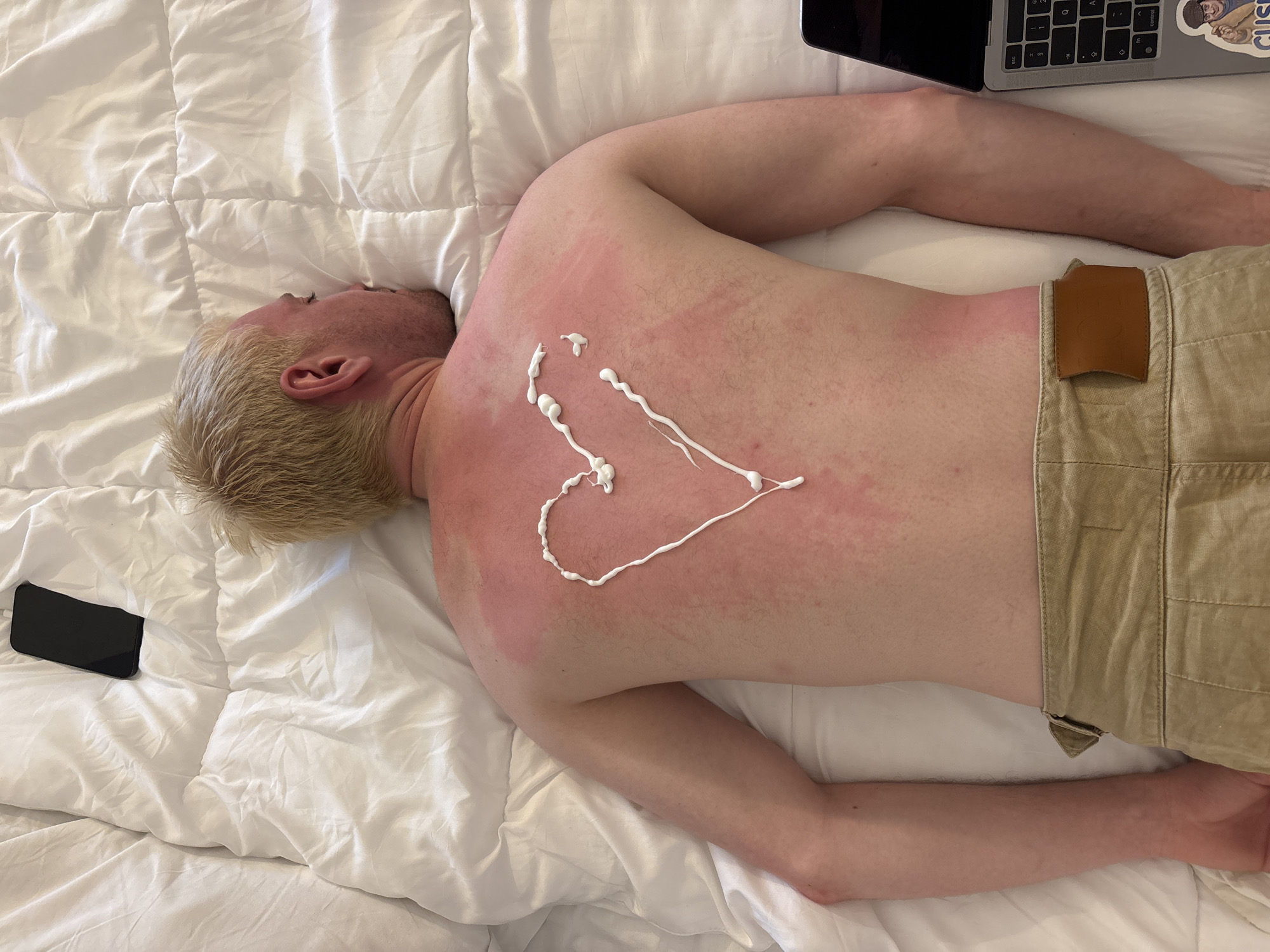 A pale-skinned individual lies face-down on a white, quilted bedspread. The person's back and shoulders exhibit a sunburn, with redness concentrated around the upper back and shoulder areas. A heart shape is drawn on the back using a white cream or lotion. The person wears light khaki-colored shorts. A black smartphone is positioned near the head on the bed, and a laptop with a sticker on it is visible near the upper right of the image. The location is not identifiable from the image alone.
