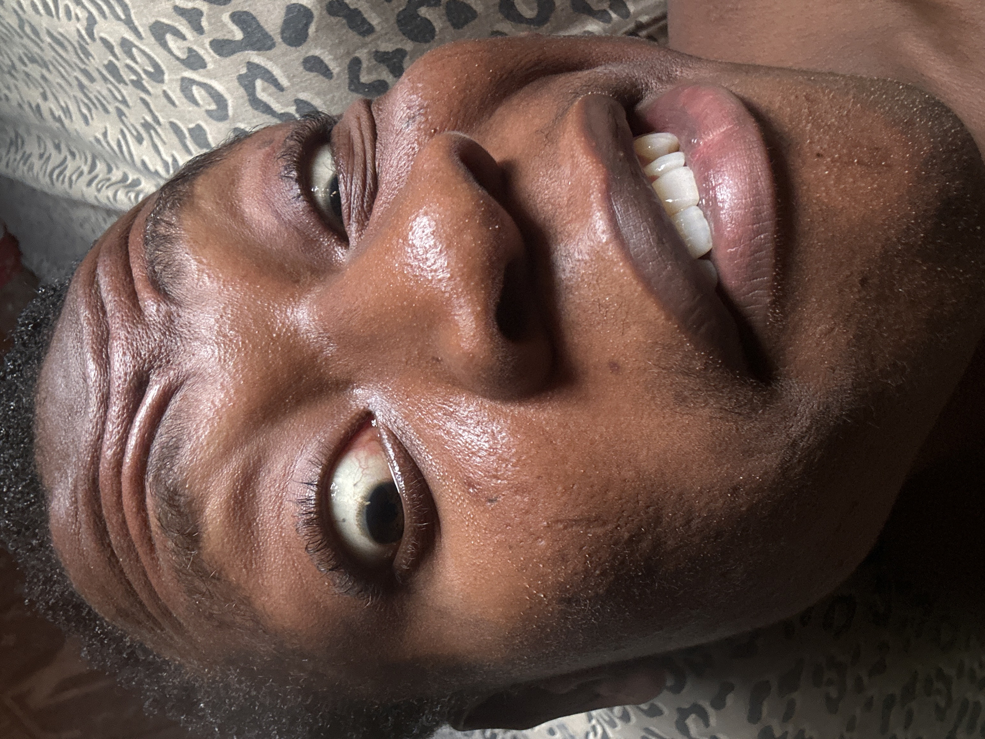 A close-up photograph shows a person's face from a low angle, tilted to the side. The person has dark skin, brown eyes, and white teeth visible through their lips. The skin appears somewhat oily, and fine details like pores and eyelashes are discernible. The background includes a patterned fabric, possibly bedding. The location is Unknown, Unknown.