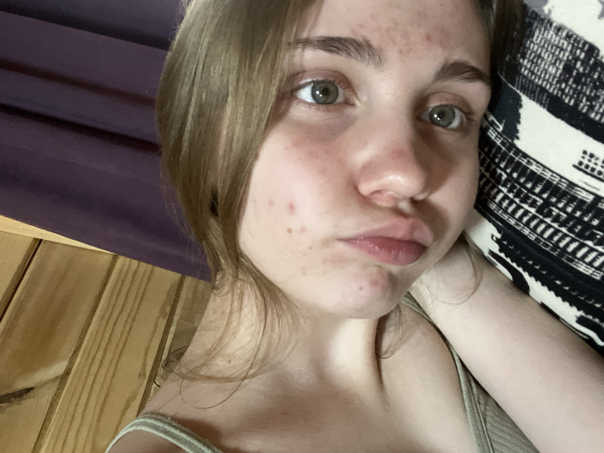 The image shows a close-up, head-and-shoulders view of a young person with light brown hair and green eyes, lying down and looking towards the camera. The person appears to be indoors, with wooden paneling visible in the background, suggesting a rustic or cabin-like setting. A dark purple curtain is also visible in the upper right portion of the frame. The person is wearing a light-colored tank top. The skin has some redness and blemishes, particularly on the cheeks. The person's head is resting on a patterned surface, possibly a pillow or blanket, which is black and white with a geometric design. The lighting is soft, and the image is taken from a slightly upward angle, emphasizing the person's face. There is no indication of the specific location within the city of Ashkadar, Russia, as the image contains no discernible landmarks or contextual elements that would place it in that city.