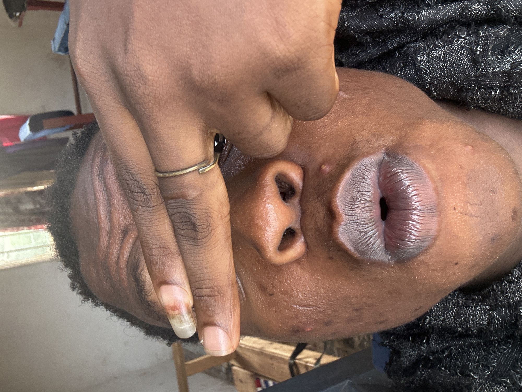 A close-up photograph features the face of an individual with dark skin, positioned at an angle. The subject's lips are prominently displayed, appearing swollen and bluish-gray in color. A hand with a gold ring on one of the fingers touches the face near the nose. There are visible imperfections on the skin, including small blemishes and scars. The background is partially obscured but suggests an indoor setting with hints of furniture and fabric. The photo's orientation is rotated, making the subject appear sideways. The city and specific location are Unknown, Unknown.