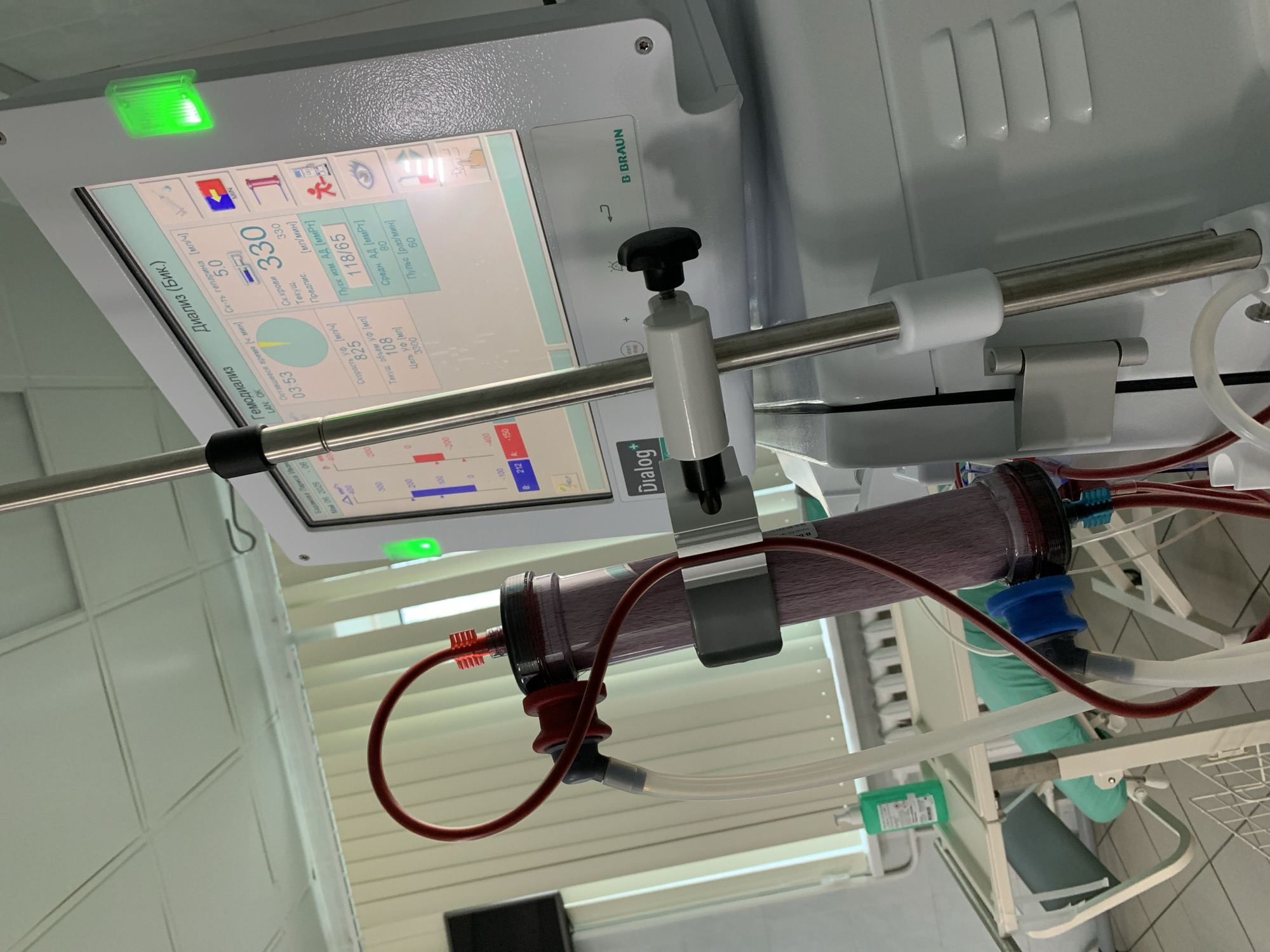 A close-up shot shows a dialysis machine with a visible blood filter and various tubes connected to it. The machine's screen displays medical data in Russian, indicating a dialysis session in progress. The location is likely a hospital or clinic, indicated by the tiled walls and medical equipment. The screen displays 'Диализ (Бик.)' and the text 'Диализ (Бик.)' which is in Russian, roughly translates to Dialysis (Bik). This suggests the image was taken in Chaikovsky, Russia, specifically at the 'Бик.' dialysis center. The shot angle is from slightly below, looking up at the machine.