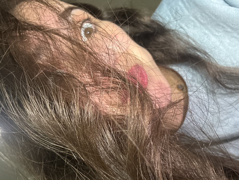 A close-up shot of a woman's face partially obscured by brown hair. Her eye is visible, gazing upward. Red marks are visible on her cheek. The background shows a blue fabric. The overall impression is a casual, slightly messy selfie.