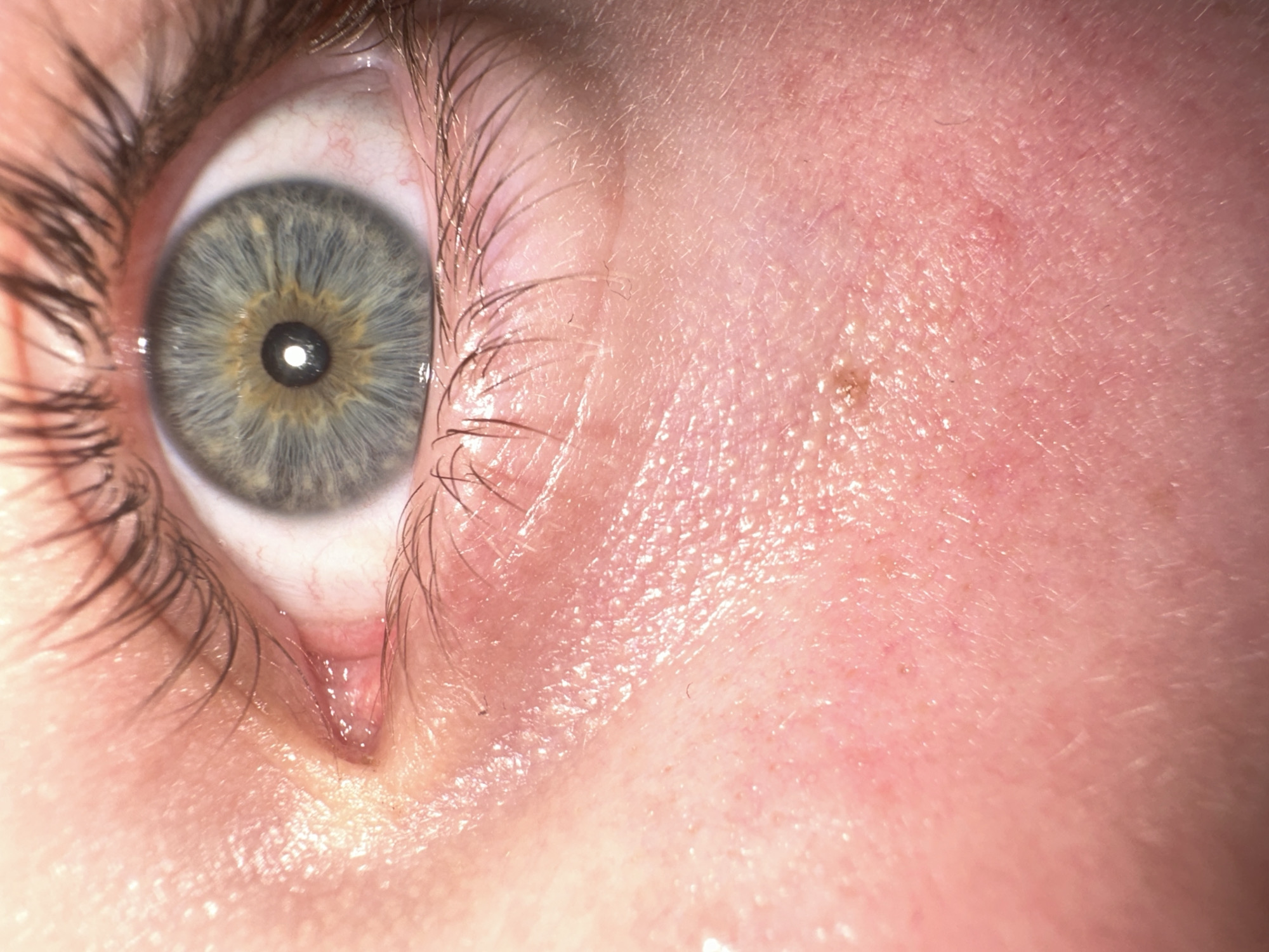 A very close-up, high-resolution image captures a human eye and the surrounding skin. The primary subject is the eye, characterized by a striking iris that transitions from a light blue-grey on the outer perimeter to a distinct ring of golden-brown immediately surrounding the pupil. The pupil itself is dark and round, with a prominent white reflection indicating a direct light source, likely a camera flash or a lamp.
The sclera (white part of the eye) shows a few faint, reddish blood vessels. Long, dark eyelashes frame both the upper and lower eyelids. The skin around the eye is fair-toned, exhibiting visible pores and fine lines. There is noticeable redness, particularly in the inner corner of the eye and extending onto the cheek area to the right. A small, slightly raised, brownish mark, possibly a mole or freckle, is visible on the skin to the right of the eye. The lacrimal caruncle and plica semilunaris are visible in the inner corner of the eye, appearing moist. No specific activity is occurring; it is a static portrait. The extreme close-up limits any discernible background or location cues, and no text is visible.