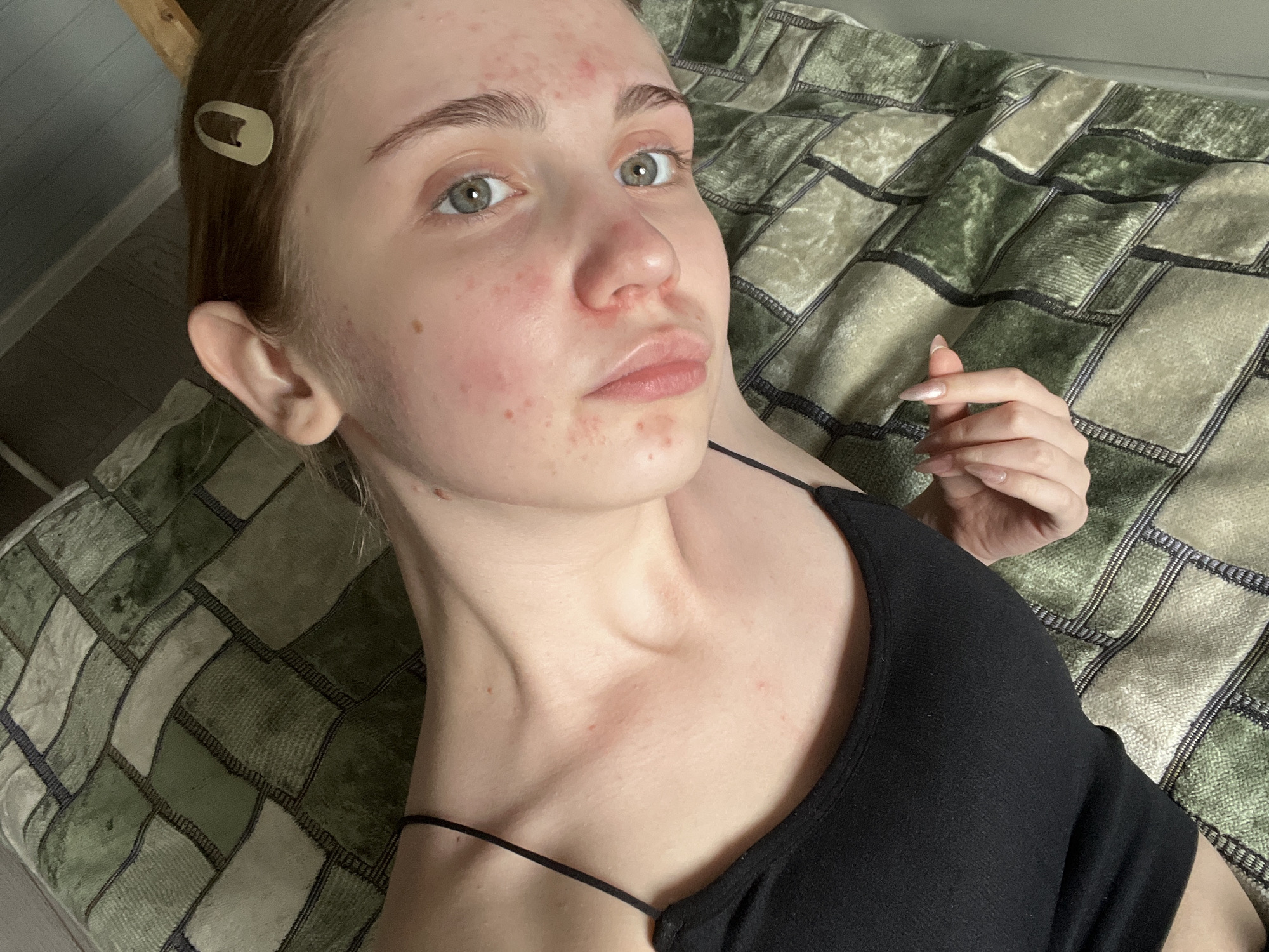 The image shows a close-up, overhead shot of a young woman lying on her side on a green, patterned surface. She has light skin with some redness and blemishes on her face and neck. Her eyes are open and looking towards the camera. She is wearing a thin, black strap top. Her hair is brown and a light-colored hair clip is visible. Her left hand is resting on the surface near her chest, with manicured fingernails. The green surface appears to be a blanket or bedspread with a brick-like pattern. There is no indication of the city of Ashkadar, Russia, or any specific location within it.