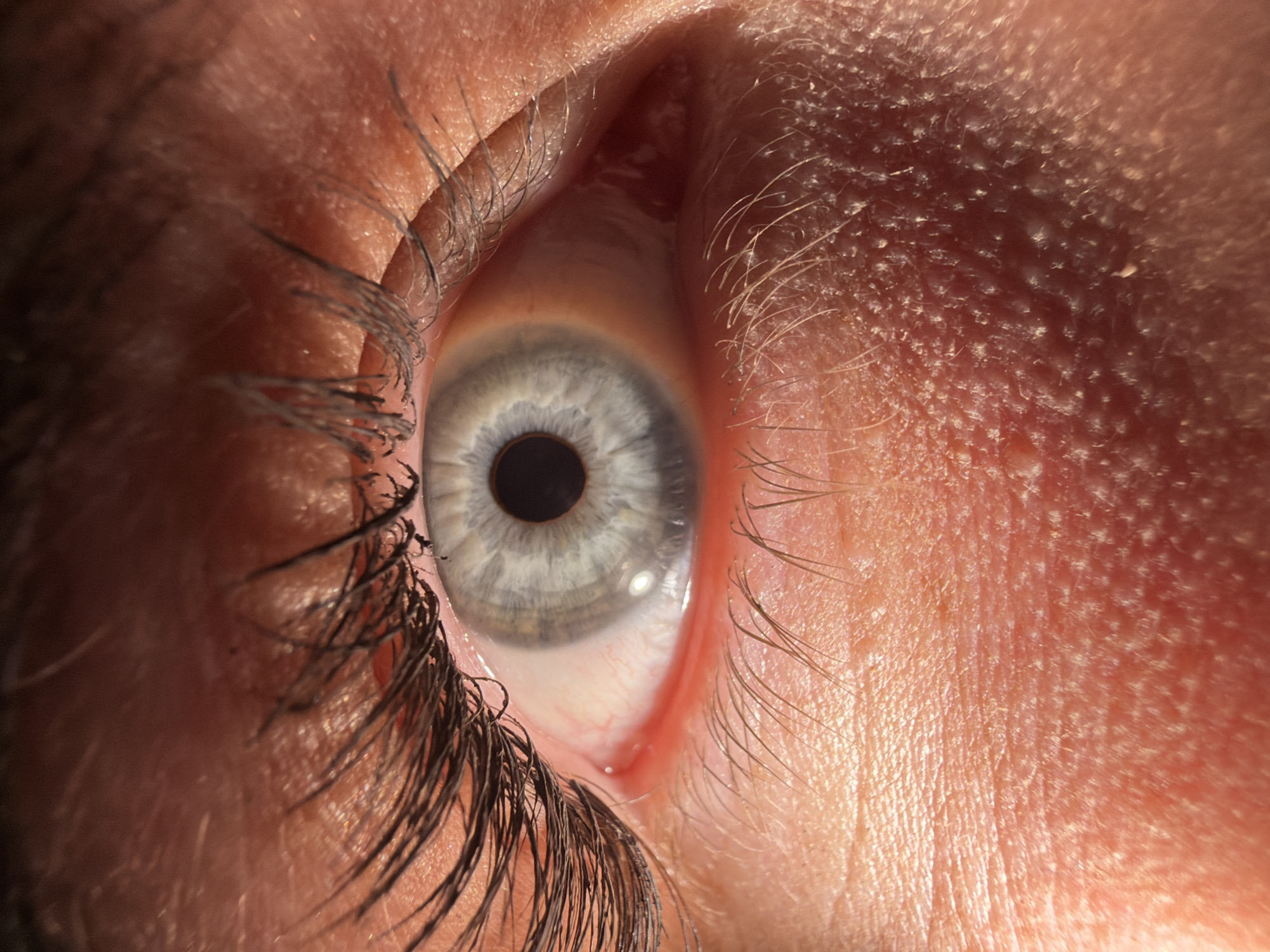 This image is a close-up shot of a human eye. The iris is a pale grey-blue color with a black pupil. The surrounding sclera is tinged with red veins. Eyelashes are visible on both the upper and lower lids. The skin around the eye appears rough and textured. Location: Unknown, Unknown.