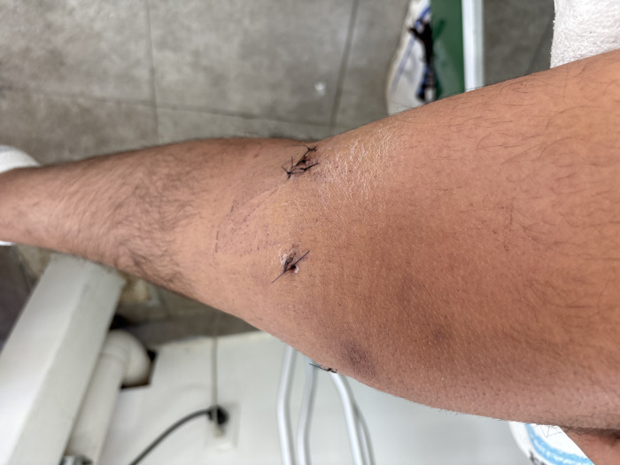 A close-up shot captures a light-skinned arm with sparse hair, featuring two distinct surgical wounds closed with sutures. The larger wound at the upper arm appears to have several stitches, while a smaller wound lies closer to the center. Fine red lines surround the sutures. The arm rests against a backdrop of a white sink and a tiled floor. A sneaker can be seen in the periphery.