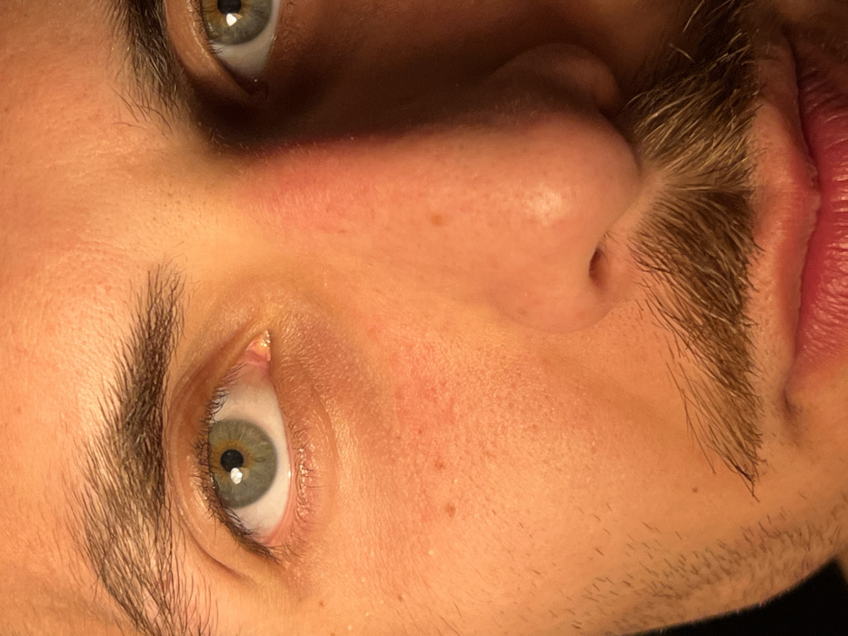 This image depicts a close-up of a human face, documented in Rafailovići, Montenegro. The scene captures the area from above the eyebrows to the upper lip of an individual. The subject exhibits light skin with a warm, orange-red hue, indicating specific lighting conditions. Both eyes are open; the visible left eye (viewer's right) features a blue-green iris with a dark pupil and a singular white specular highlight. The right eye (viewer's left) is partially visible, showing similar characteristics. Dark eyebrows are present above both eyes. A light brown mustache is visible above the upper lip, and sparse stubble is present on the cheeks and lower facial area. The bridge and tip of the nose appear slightly reddened. Small reddish irregularities, consistent with blemishes or freckles, are observable on the skin, notably on the left cheek and across the bridge of the nose. The illumination source is strong and originates from the upper-left of the viewer's perspective, casting a distinct shadow down the right side of the subject's nose and face. The background is uniformly dark and devoid of detail, indicating a shallow depth of field or an unlit environment. No specific actions or interactions are discernible beyond the subject's direct gaze.