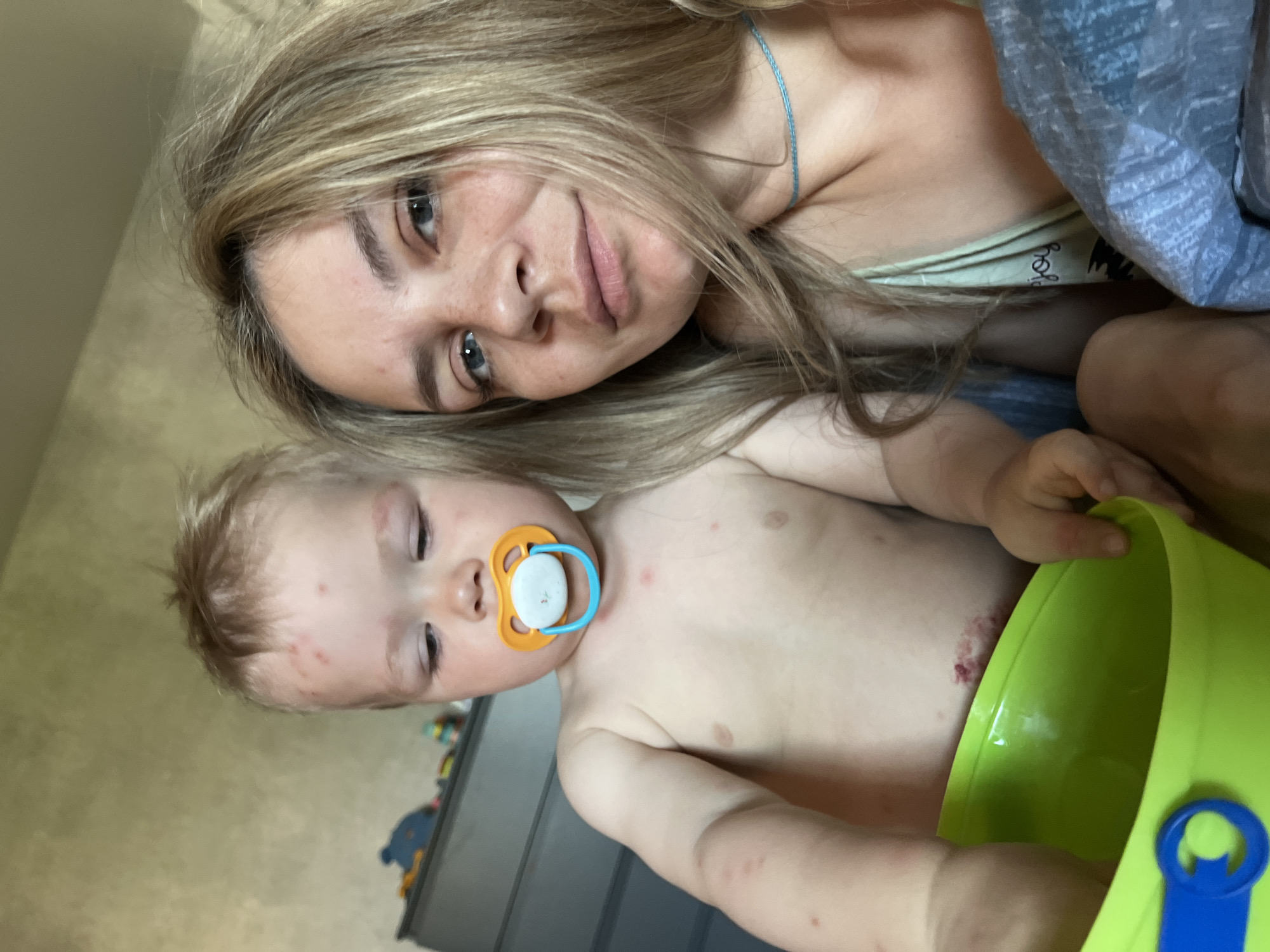 A woman with blonde hair is lying next to a baby. The baby has a pacifier in its mouth and is holding a lime green bucket. The baby has a number of small red marks on his head, chest, and arms, and a purplish scrape on his left side. The woman is looking at the camera. The setting is indoors. The city of Chaikovsky, Russia, is not visibly identifiable in the image.