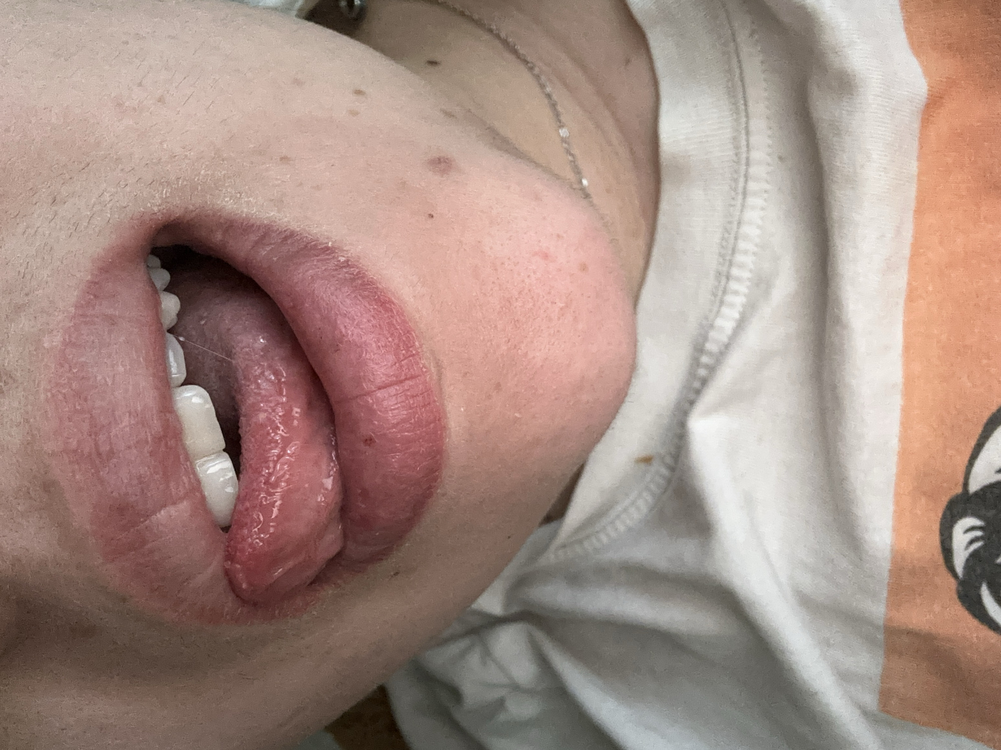 A close-up, angled perspective of a person's face, focusing on the mouth area. The mouth is open, revealing white teeth and a pink tongue. The lips appear dry and somewhat chapped. The surrounding skin shows signs of dryness and possibly some irritation. A silver necklace is visible near the neck. The person is wearing a white T-shirt with a graphic design featuring black and orange colors. The background is blurred. There is no information that indicates the location is Sofia, Bulgaria.