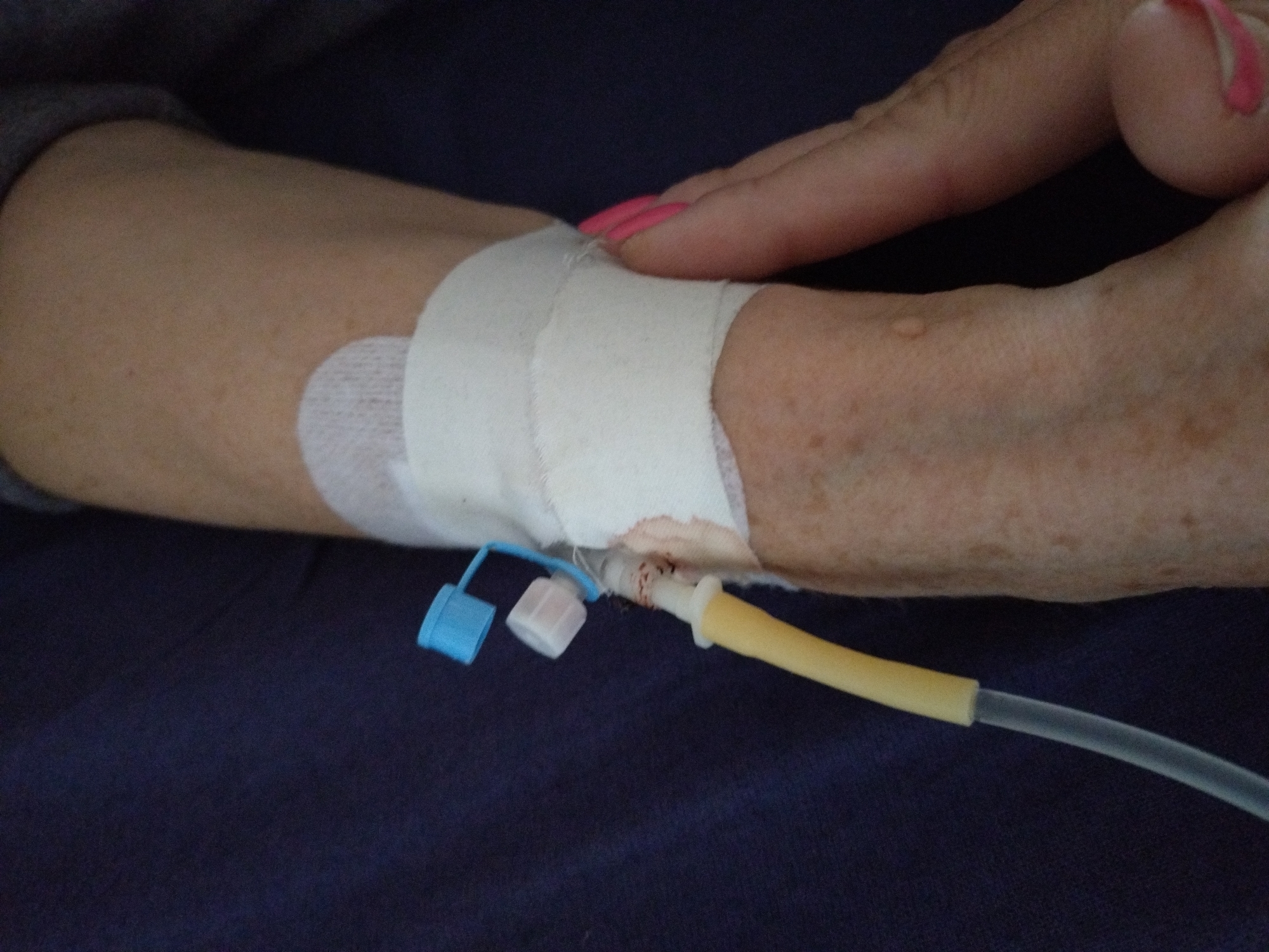 A person's arm lies on a dark blue surface. An IV line is inserted into the arm, covered with white gauze and tape. A hand with pink painted nails rests on the arm near the IV site. There is a yellow tube and blue/white connector on the IV line. The context suggests this is a medical setting. There is no specific information to determine if the location is Stara Zagora, Bulgaria.
