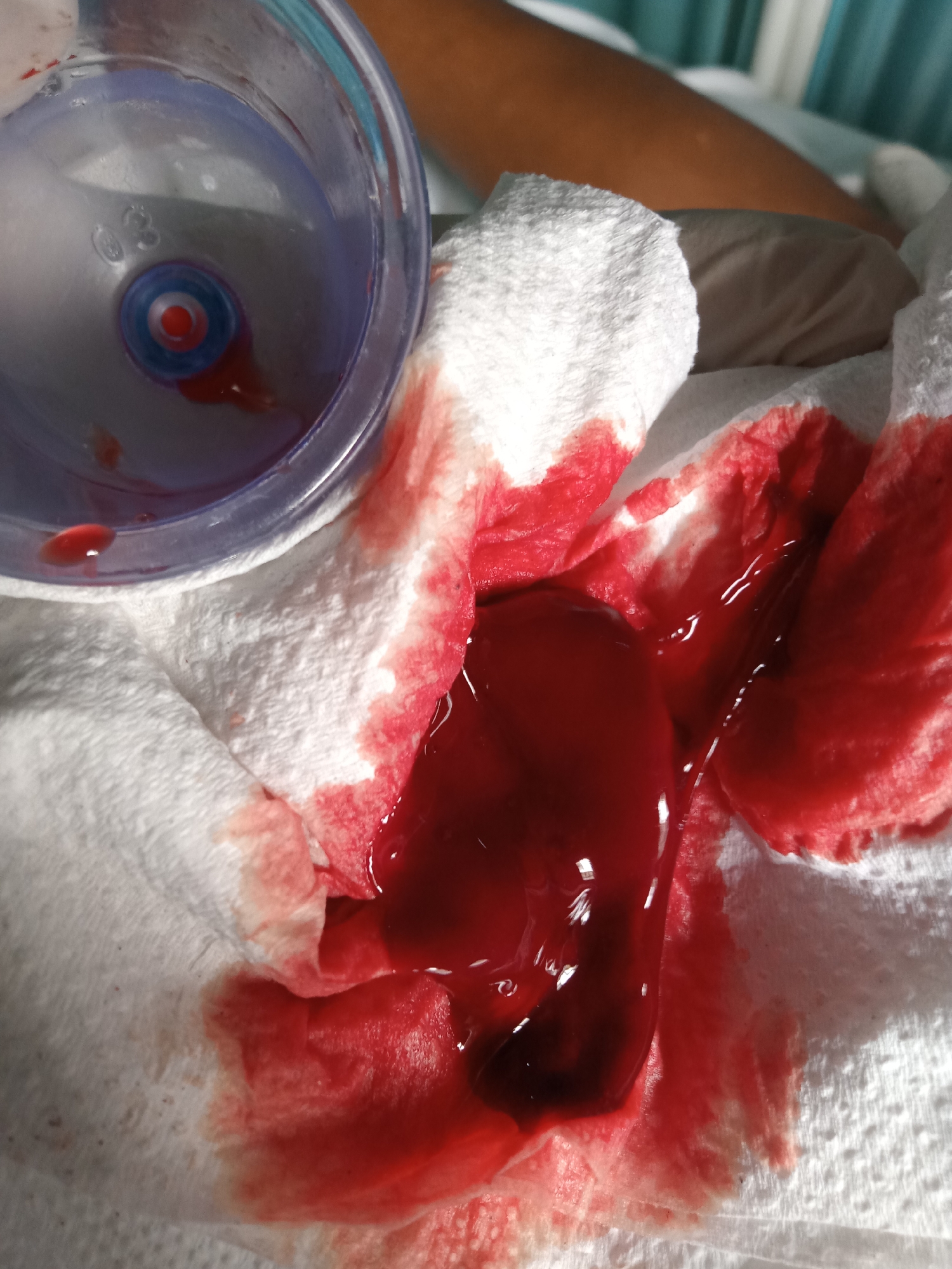 The image shows a white paper towel heavily stained with blood. In the center of the towel is a dark red, semi-solid mass. A translucent plastic cup with a red and blue valve at the bottom is positioned to the upper left, containing a small amount of blood. The setting appears to be a medical facility, possibly in Gwarinpa, Nigeria. A portion of a person's arm and hospital bed linen can be seen in the background.