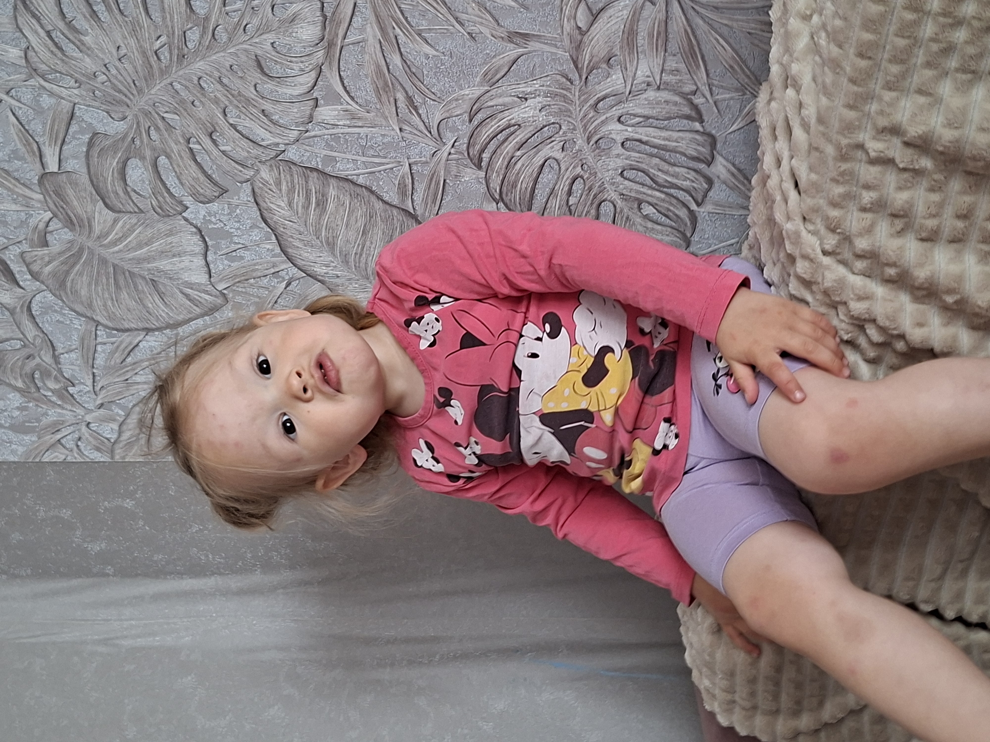 A young child with light-colored hair styled in two small buns is seated upright, facing forward, in a domestic setting within the city of Unknown, Unknown. The child wears a long-sleeved pink top adorned with cartoon characters and light purple shorts. Numerous small, reddish papules are visible on the child's forehead, cheeks, and both knees, suggesting a dermatological condition. The child's lips are pursed, and the eyes are dark and wide open, directed towards the viewer. She is positioned on a light brown or beige textured blanket or cushion, which displays a raised, dimpled pattern. The background features two distinct sections of wallpaper: the left side is a light gray with a subtle, mottled texture, while the right side displays a dark gray wallpaper patterned with large, stylized, embossed tropical leaves in varying shades of gray and brown.