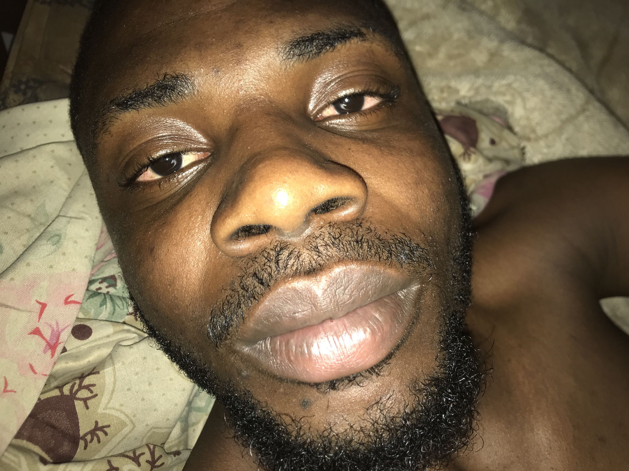 A close-up, eye-level portrait features an adult Black male lying on his back, looking directly into the camera. The subject has dark skin, which appears reflective across the forehead, nose, and cheeks. His eyes possess dark brown irises with visible pupils, and the sclera of both eyes shows a degree of redness, particularly pronounced in his right eye (viewer's left). His eyebrows are well-defined with dark, coarse hair, and short dark eyelashes are present. He has a broad nose with visible nostril hairs. His lips are full, fleshy, and slightly parted, exhibiting a glossy, light pinkish-brown coloration, with the upper lip appearing more reflective. A sparse to medium-density black beard and stubble cover his chin, jawline, and upper lip. A small, dark, circular mole is visible on his chin, slightly left of center. The top of his head shows close-cut dark hair. His bare right shoulder and upper chest are visible on the lower right of the frame. The background consists of soft bedding. On the left, a fabric with a floral pattern featuring pink, green, and brown elements on a beige background is visible. On the right, a cream-colored, textured fabric, likely a blanket or sheet, is present, with an indistinct, lighter-toned object further in the background. The lighting is subdued, suggesting an indoor setting. This scene is located in Rafin Par, Nigeria.