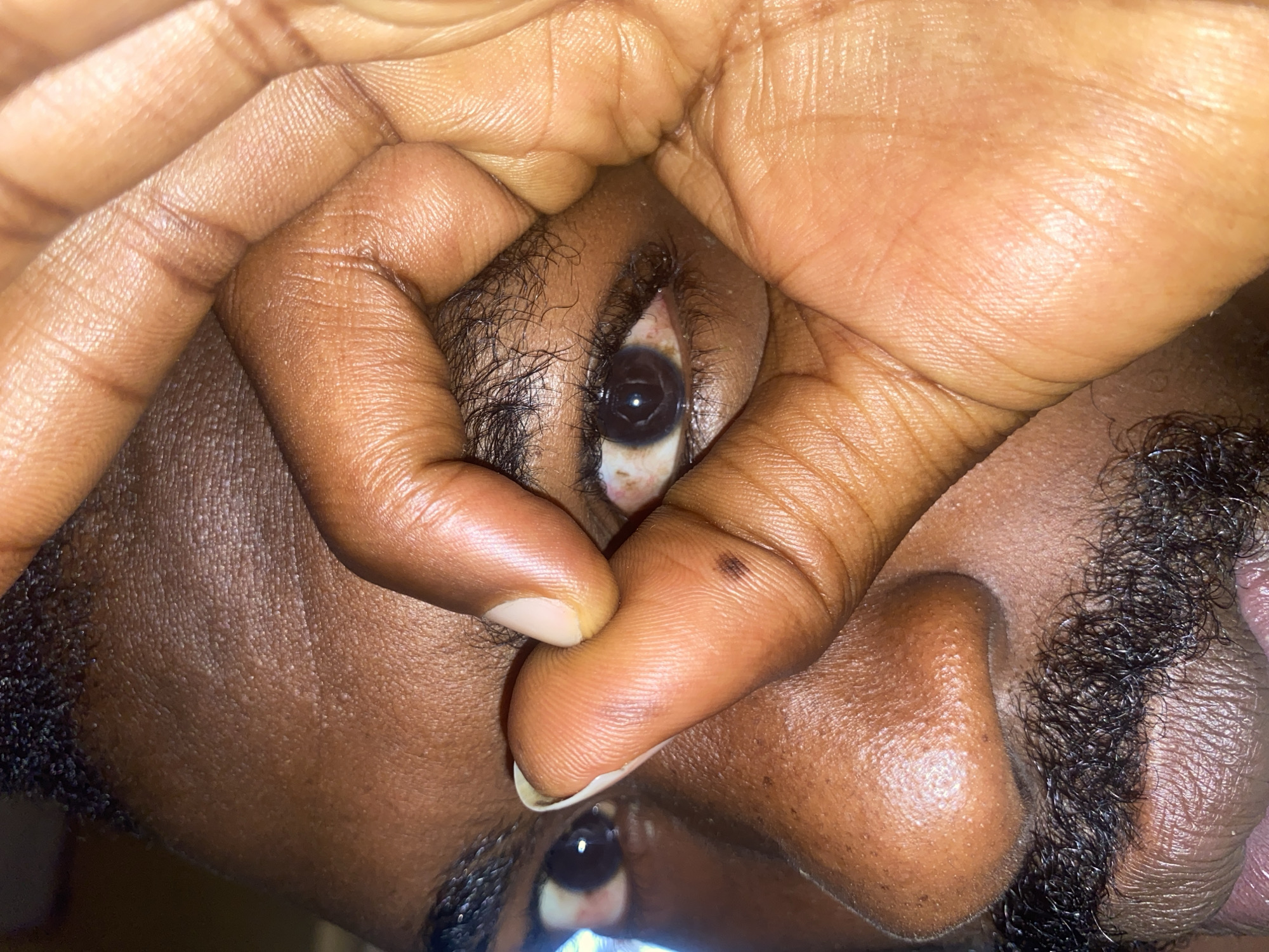 A very close-up, vertically oriented image captures a person's dark-skinned face, primarily focused on one eye being held open by fingers. The subject's eye features a dark brown iris, a black pupil, and a sclera with visible reddish blood vessels, particularly prominent towards the inner corner near the nose. Dark eyelashes frame the eye, and parts of the eyebrow are also visible.
The fingers, matching the subject's dark skin tone, are pressing firmly against the skin around the eye, causing slight creasing. A small, dark mole is noticeable on one of the fingers near the outer corner of the eye. Fingernails are visible on some of the fingers.
Below the eye, parts of the nose and lower facial area are visible, featuring dark, curly facial hair, possibly indicating a beard or stubble. The lighting appears to be direct and artificial, creating highlights on the skin and distinct reflections within the pupil. There is no visible text in the image. The provided location context is Barakin Akawo, Nigeria, though no specific visual cues in the image confirm this.