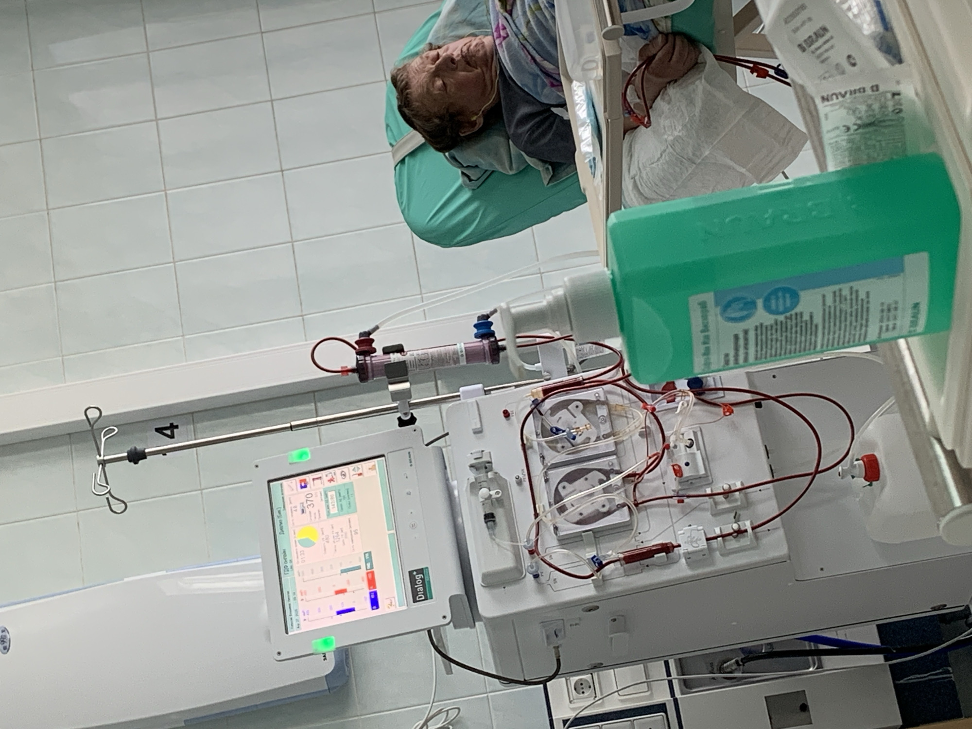 The image shows a patient undergoing hemodialysis, likely in a hospital or clinic. The patient is lying on a bed, connected to a dialysis machine with red tubing. A bottle of B. Braun solution is visible near the machine. The machine's screen displays information related to the dialysis process, including readings for ГДФ онгойм (filtration rate) and Дигама (Бик) (dialysis time). The machine is labeled "Dialog."
The image appears to be taken in a hospital setting, characterized by tiled floors and walls. A metal pole with hooks hangs nearby, suggesting it's used for holding IV bags or other medical equipment. The number "4" is visible on the wall near the pole. The presence of the Dialog machine indicates a modern medical facility. The city and country are explicitly provided in the prompt. Therefore, the location is a hemodialysis unit within a medical facility in Chaikovsky, Russia.