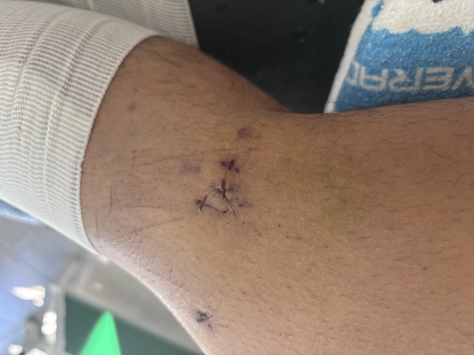 An arm with surgical sutures, bruising, and visible skin markings. The arm is bandaged near the wrist. There are two sets of stitches visible. The larger wound site has three stitches forming a triangular shape. A smaller set of stitches is visible toward the bottom of the frame. Hair follicles are present on the arm. A blue and white towel is visible near the elbow. A green object can be seen in the lower left of the frame.