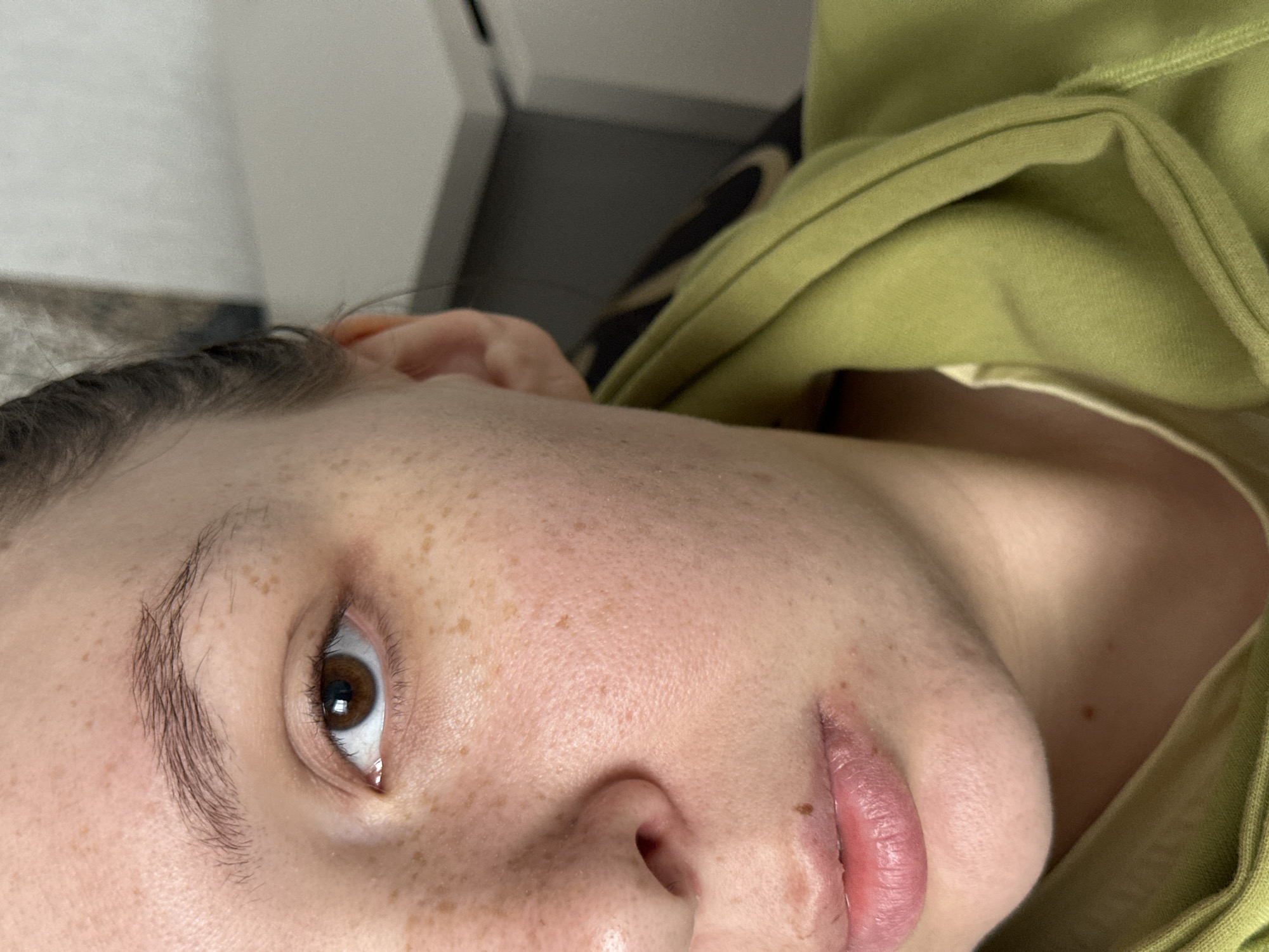 The image is a close-up of a person's face, showing the left eye, nose, mouth, and part of the neck, as well as the shoulder and chest covered by a light green hoodie. The person has fair skin with freckles across the cheek and nose. There are small blemishes or pimples around the mouth and chin. The person's eye is brown, and their eyebrows are dark and lightly shaped. The background is blurred and appears to be an indoor setting, possibly a room with furniture. The image does not provide any information about the city of Chaikovsky, Russia.