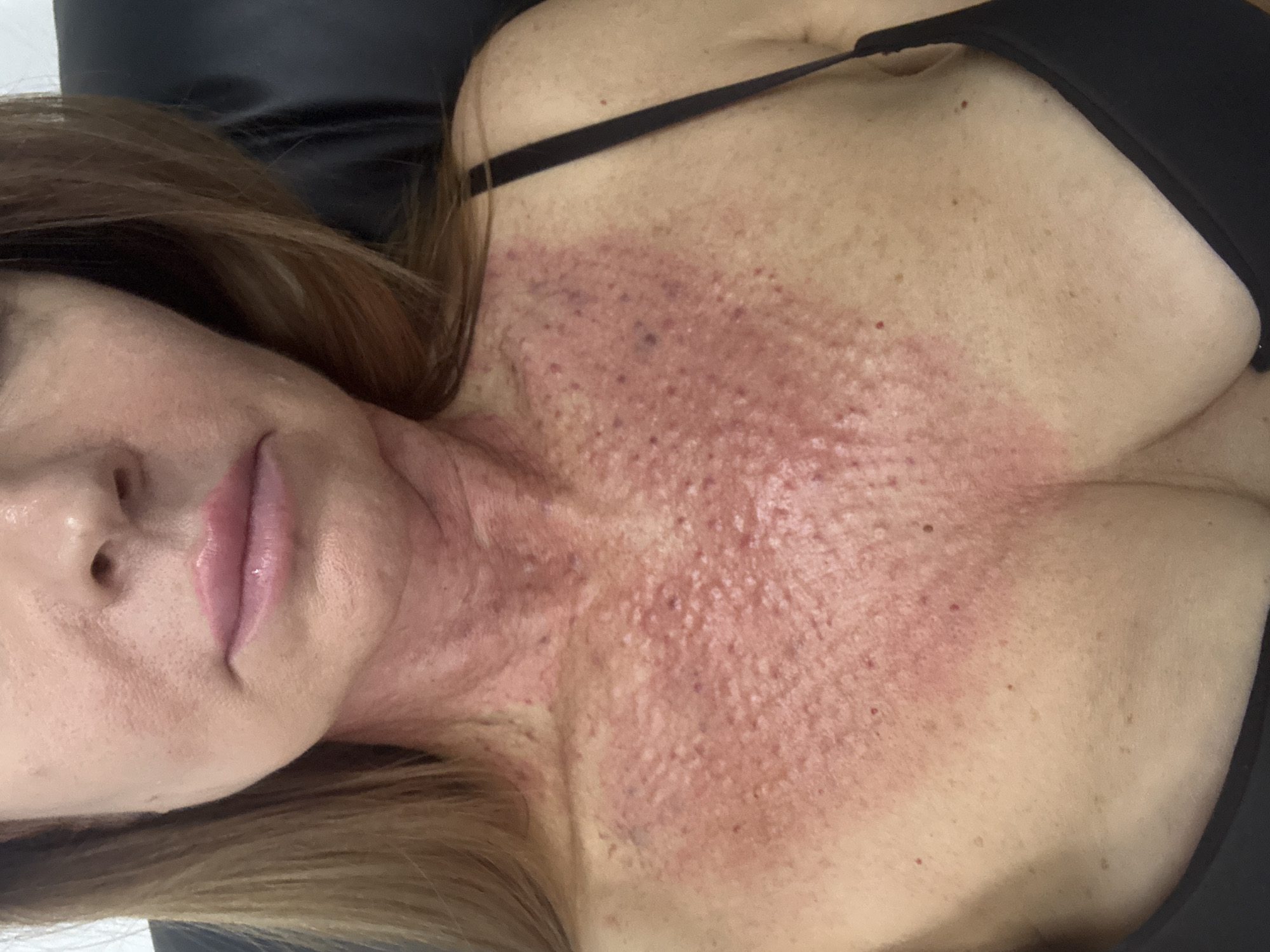 A close-up, chest-up view of a woman's face, neck, and upper chest shows a significant skin reaction. The woman's skin appears flushed and has a textured appearance, with numerous small, red bumps and some darker spots. This reaction is most prominent on her upper chest and neck, extending up to just below her jawline. Her lips are a pale pink and appear slightly swollen. She is wearing a black bra. The background is dark and out of focus, suggesting she is indoors, possibly in a chair. There is no information available about the location in the city of Dnipro, Ukraine.