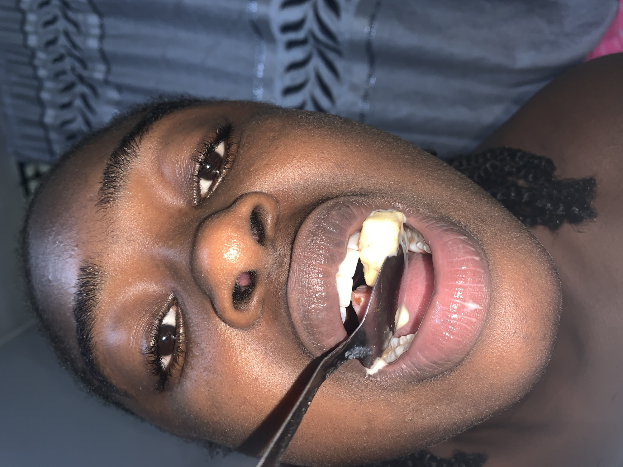 The image presents a close-up, angled view of a person, likely a young individual, with dark skin. The individual has dark, braided hair visible on the right side of the frame. They are looking directly at the camera with their eyes open. Their mouth is wide open, and a metal spoon containing a light-colored, semi-solid substance is inserted into it, suggesting they are in the process of eating or being fed, or possibly taking medicine. Traces of the substance are also visible on their tongue and teeth. The background features a dark-colored fabric with a subtle, lighter pattern, indicative of an indoor setting. The person's expression appears neutral. There are no discernible cues for the time of day or weather. No text is visible in the image. The scene takes place in Rafin Par, Nigeria.