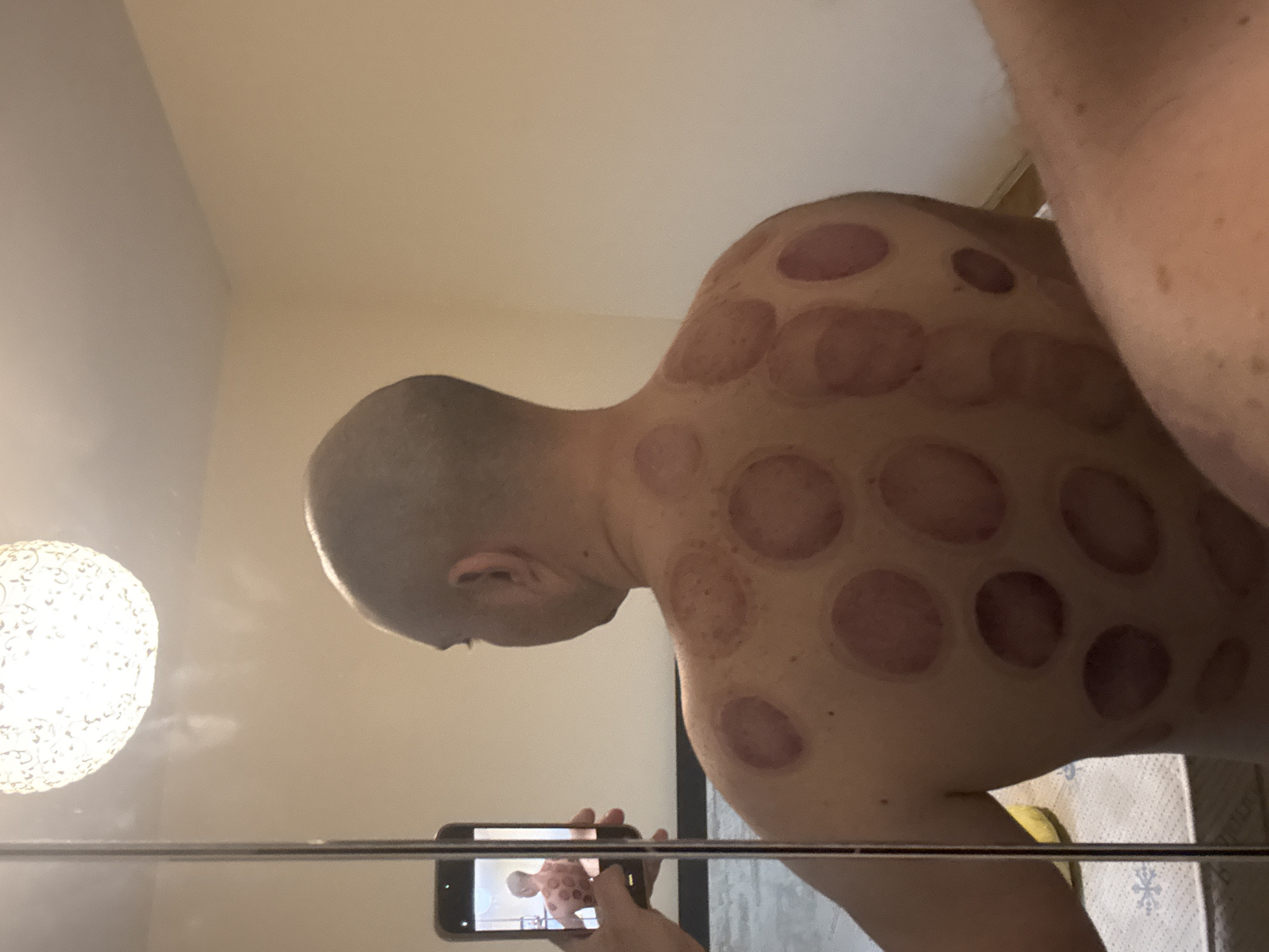 The scene depicts a male individual's bare upper back and shoulders, displaying numerous circular, reddish-purple ecchymoses consistent with cupping therapy. The individual has a shaved head and is viewed from behind, reflected in a large vertical mirror. A hand, visible in the mirror's reflection on the left, holds a black smartphone, with its screen showing the reflected image of the man's back, indicating a photograph is being taken. Above the reflection of the man's head, a spherical, ornate white ceiling light fixture is also reflected. The reflected background reveals plain, light-colored walls and, in the lower left, a portion of a mattress with a white sheet patterned with blue snowflake-like designs. This indoor scene is situated in the city of Pleven, Bulgaria.