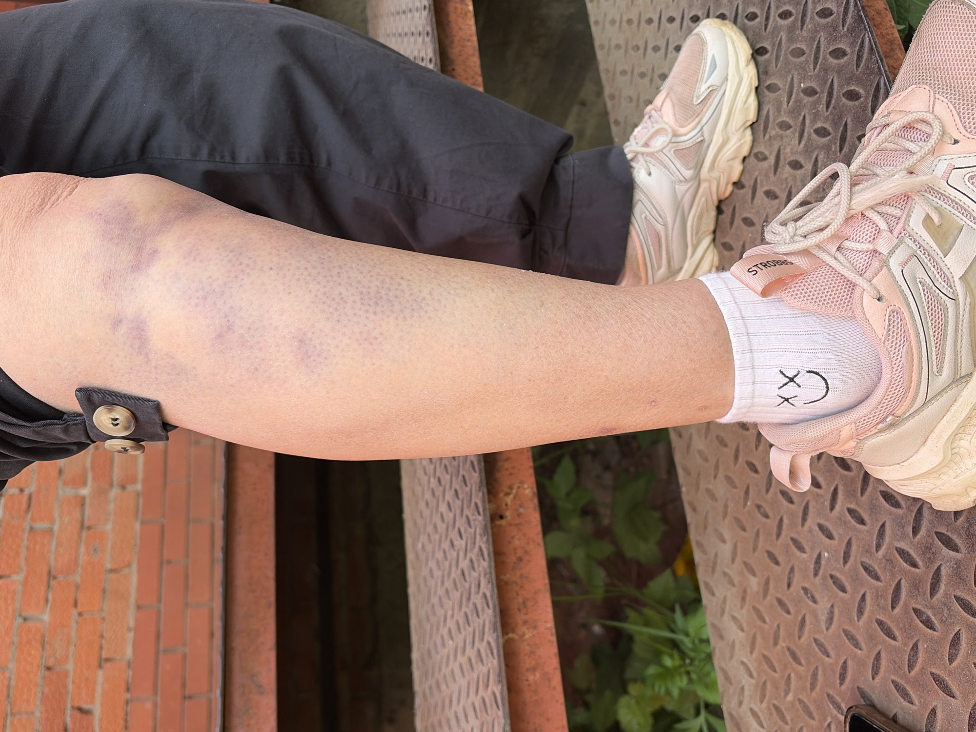 The image shows a person sitting with their leg extended, revealing a large bruise on the knee and upper shin. The person is wearing dark pants and white socks with a smiley face design. The feet are clad in pastel-colored athletic shoes. The setting appears to be outdoors, with a metal staircase or grate visible beneath the leg and footwear. A brick wall is partially visible on the left, and foliage can be seen in the background. The exact location is unclear, but based on the prompt, it is inferred to be in Chaikovsky, Russia.