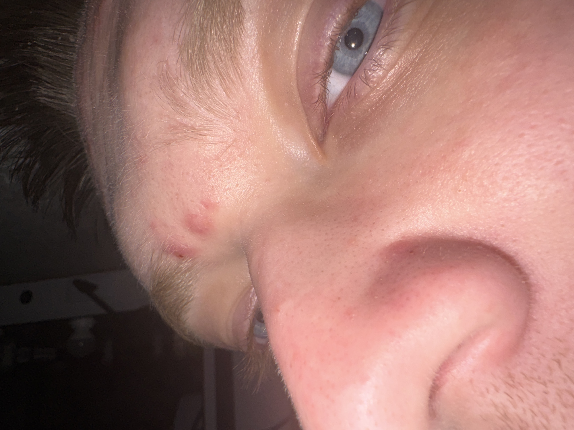 The image is a close-up, head-and-shoulders shot of a person's face, focusing on the forehead and the area around the left eye and nose. The person appears to have light skin with some visible pores and what looks like a small, red pimple or lesion on the forehead, slightly above the left eyebrow. There are also some minor red areas or blemishes on the cheek and nose. The individual has light-colored eyebrows and dark hair is visible at the top of the frame. The left eye is open, revealing a blue iris and dark eyelashes. The lighting suggests an indoor environment, possibly with a flash, as there are some bright highlights and deep shadows. The background is dark and indistinct, with no identifiable features to determine a specific location. There is no indication of Saratov, Russia in the image.