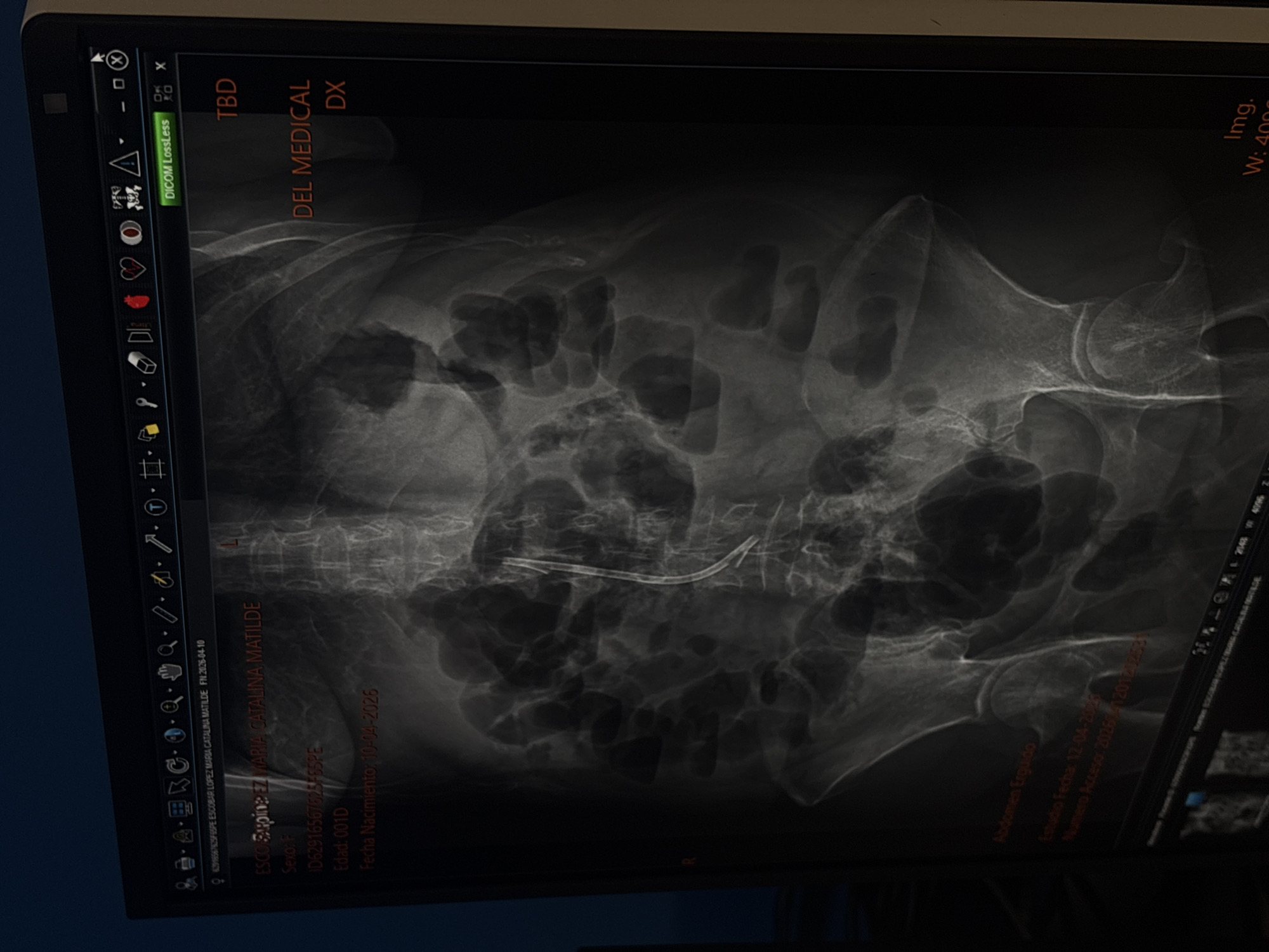 The image shows an X-ray scan of a patient's abdomen. A catheter appears to be inserted. The image includes some patient information: name (ESCOBAR LOPEZ MARIA CATALINA MATILDE), sex (F), ID (D62916567625-55PE), age (001D), and date of birth (10-04-2026). The image also contains information about the date the scan was taken (12-04-2023) and the access number (2023041201123252). The location and context are not evident in the image, nor is there an indication that it is set in Puebla, Mexico.