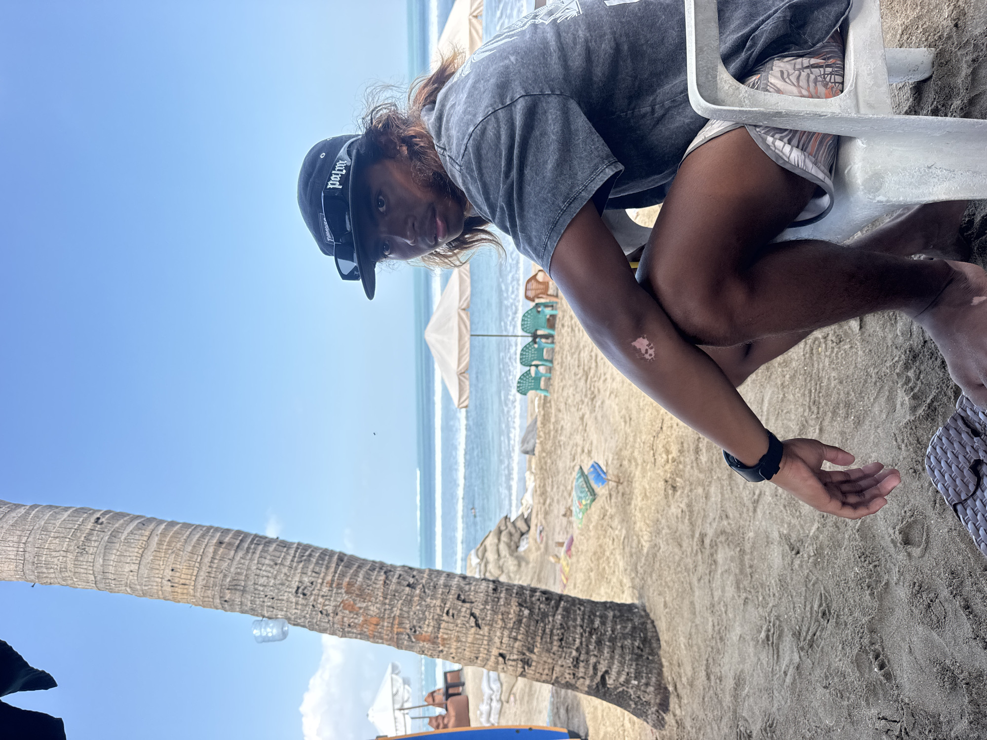 A young man with long, brown hair and a black baseball cap with sunglasses perched on top sits on a white plastic chair on a sandy beach. He is wearing a dark grey, possibly tie-dye t-shirt and patterned shorts. A black watch is visible on his left wrist. A skin condition with lighter patches is present on his left forearm. In the background, a tall palm tree stands to the left, and further back, the ocean with small waves is visible under a clear blue sky with scattered clouds. Beach chairs and umbrellas are set up on the sand, and a blue surfboard leans against a brown beanbag chair to the far left. The scene appears to be a relaxed setting on Kuta Beach, Indonesia.