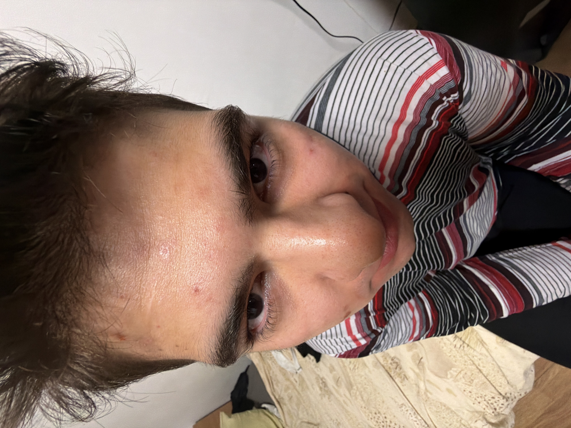A close-up, angled photograph depicts a person's face and upper body. The individual has dark hair and eyebrows, with visible skin imperfections on their forehead. The person is wearing a striped shirt with white, black, red, and gray lines. Part of a cream-colored patterned surface is visible at the bottom of the frame, along with other unidentifiable items. The background is a plain white wall at the top. The photo does not provide any information to indicate a location in Plovdiv, Bulgaria.