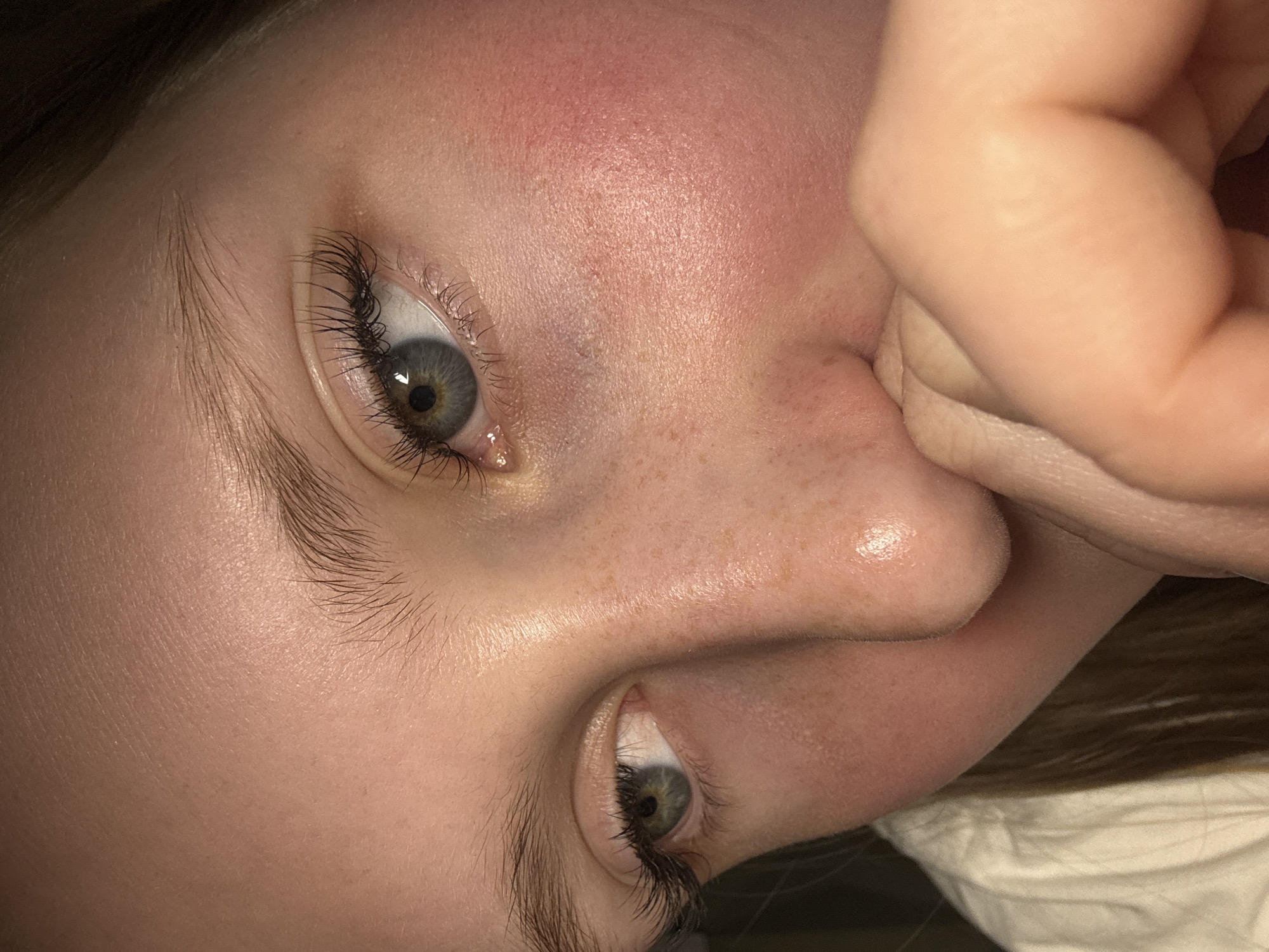 A close-up, slightly angled shot of a person's face. The individual has fair skin, freckles, and grey eyes with dark eyelashes. The forehead appears red, possibly sunburned or irritated. Their hand is partially covering their mouth and nose. A small portion of their hair and a white cloth or bedding are visible in the background. The location is not discernible from the image. There is no basis to assume it is taken in Chaikovsky, Russia.