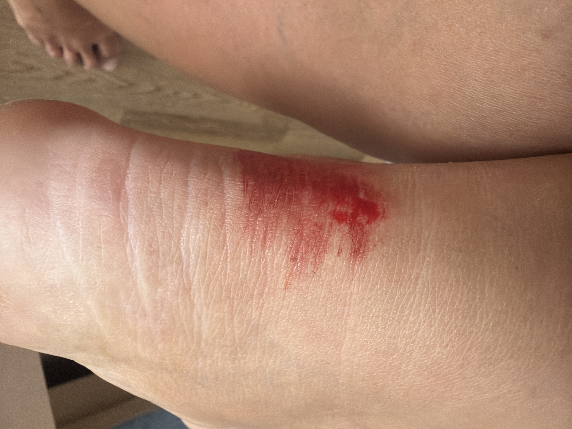 A close-up view shows a person's scraped foot or ankle with an open wound and fresh blood. The background is out of focus, showing another leg and toes. No information suggests this image was taken in Saint Petersburg, Russia.
