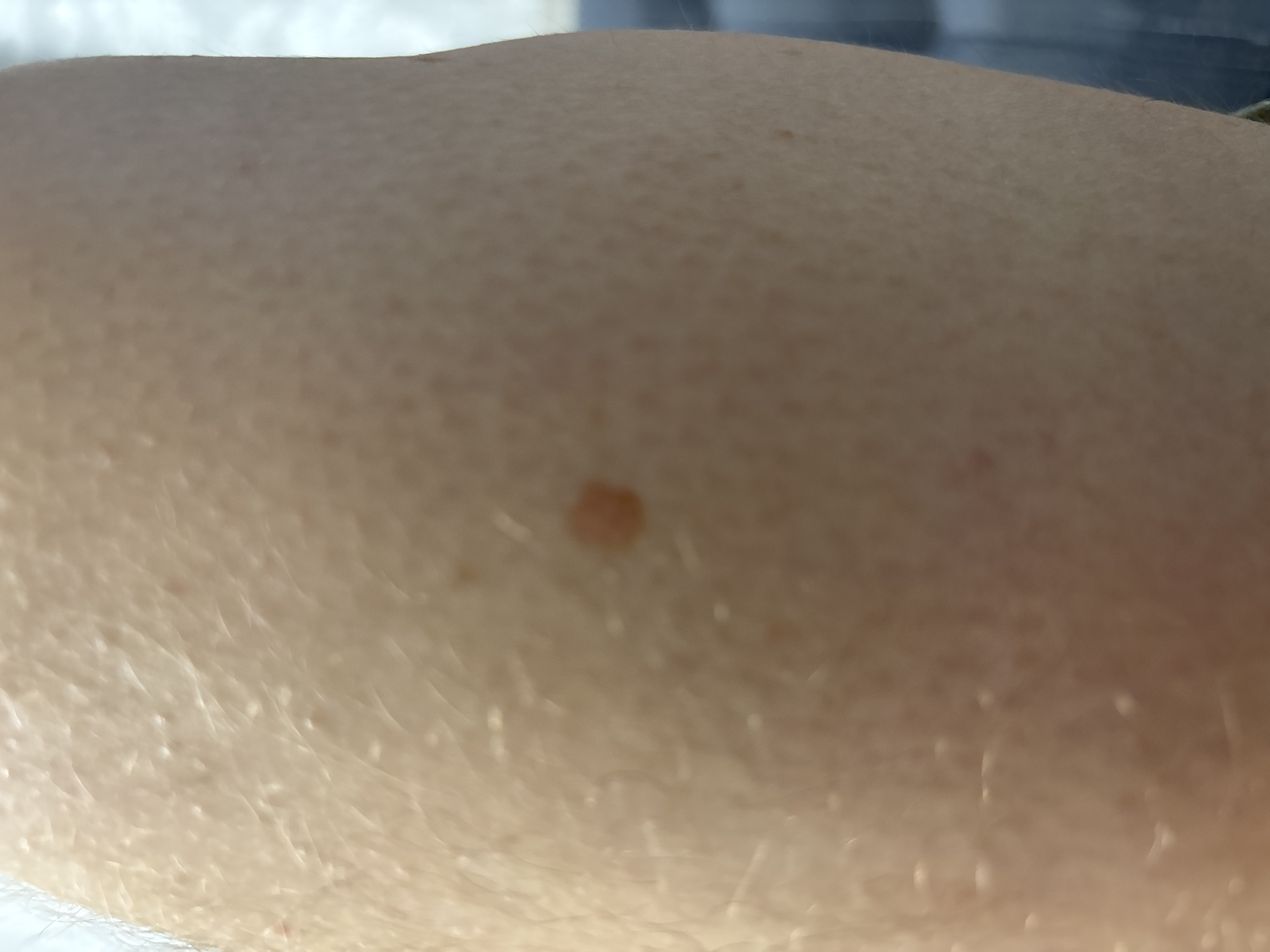 A close-up, high-angle view depicts light-toned human skin. The skin surface exhibits a coarse texture with numerous small, elevated follicular papules, indicative of piloerection or keratosis pilaris. Fine, sparse vellus hairs are visible across the skin.
Approximately centered in the frame is a single, irregularly shaped, slightly raised lesion. This lesion is tan-brown in coloration with subtle variations in pigment, including a faint reddish-orange hue within its central area. It casts a minimal shadow on its inferior-right aspect, confirming its elevation above the surrounding skin. The lesion's borders are relatively defined but not perfectly uniform.
The background is significantly out of focus, suggesting a shallow depth of field consistent with a macro photograph. No distinct individuals, objects, or actions are identifiable within the blurred background. The anatomical location on the body cannot be definitively determined from this image alone.
Location: Unknown, Unknown.