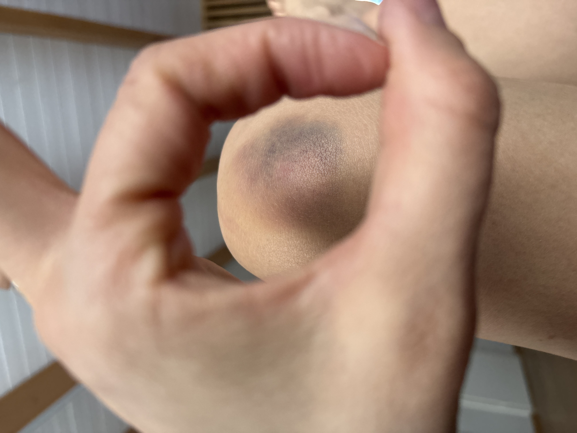 The image displays a close-up, personal view of a human knee with a prominent bruise. The bruise is centrally located on the kneecap, appearing as a dark purple-blue discoloration against the lighter skin tone. The skin around the bruise shows typical texture with fine lines and pores.
In the foreground, a human hand is heavily blurred and positioned to create a circular frame around the bruised knee. The fingers of the hand are curled, forming an "ok" gesture or a similar framing shape, directing the viewer's attention to the injury. The skin tone of the hand is consistent with that of the knee.
The background is out of focus, suggesting an indoor setting. Vertical light-colored panels, possibly blinds or part of a wall, are visible, along with some horizontal elements that might be furniture or wall trim. The lighting appears bright and natural, indicating it is likely daytime.
The overall impression is that of a casual photograph taken to document or highlight the bruise on the knee. There is no visible text in the image.