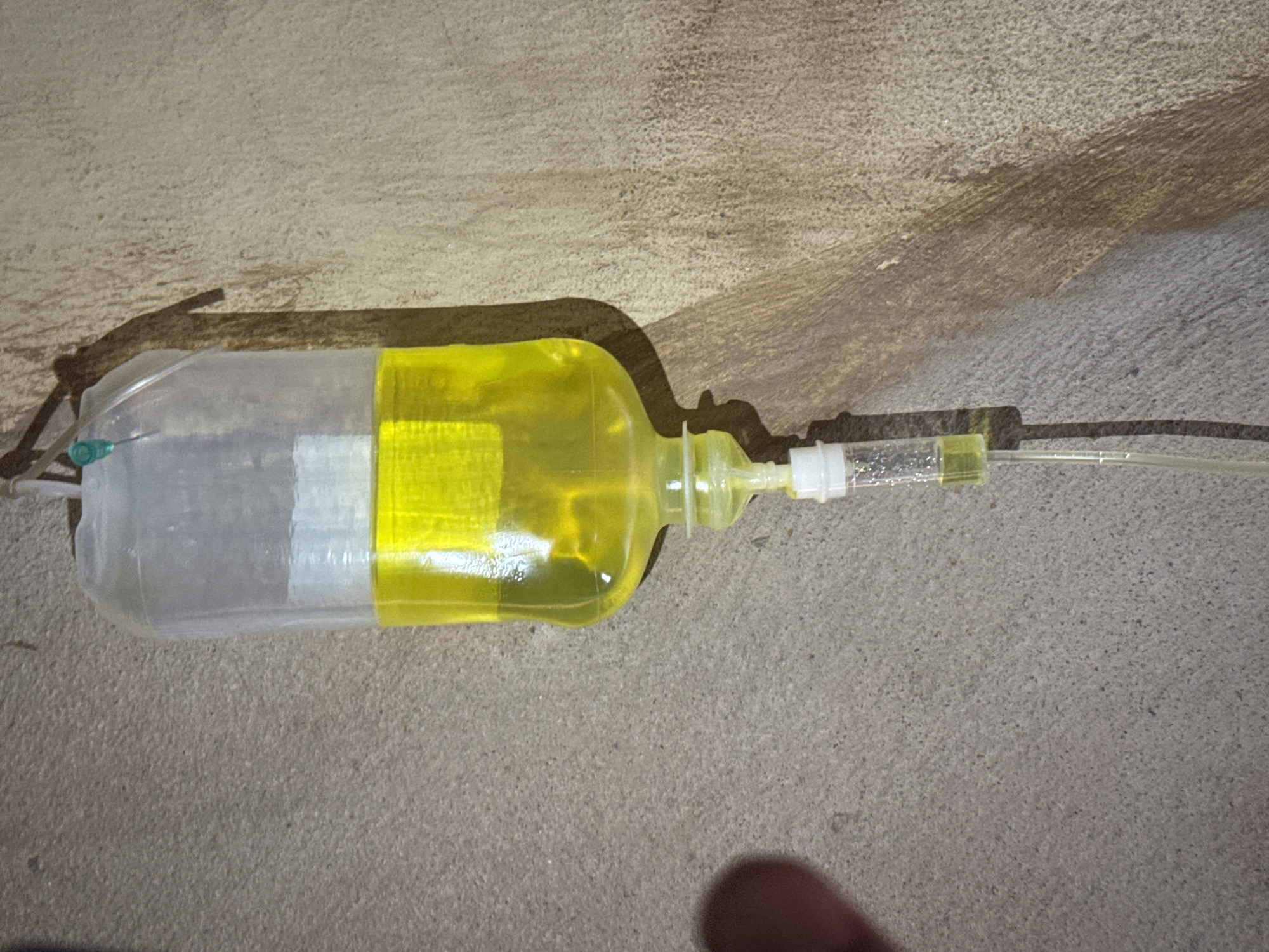 A photograph shows a partially filled intravenous (IV) fluid bag resting on a rough, grey, concrete surface. The IV bag is lying horizontally. The upper portion of the bag is filled with a clear to slightly cloudy fluid, while the lower portion contains a bright yellow fluid. A plastic tube is connected to the bag. The IV bag is casting a shadow on the concrete surface. A portion of a finger is visible in the bottom right corner. The photograph lacks information about the location in the city of Oboama, Nigeria. Therefore, no specifics about the scene or people or objects actions or interactions can be stated in relation to Oboama, Nigeria.