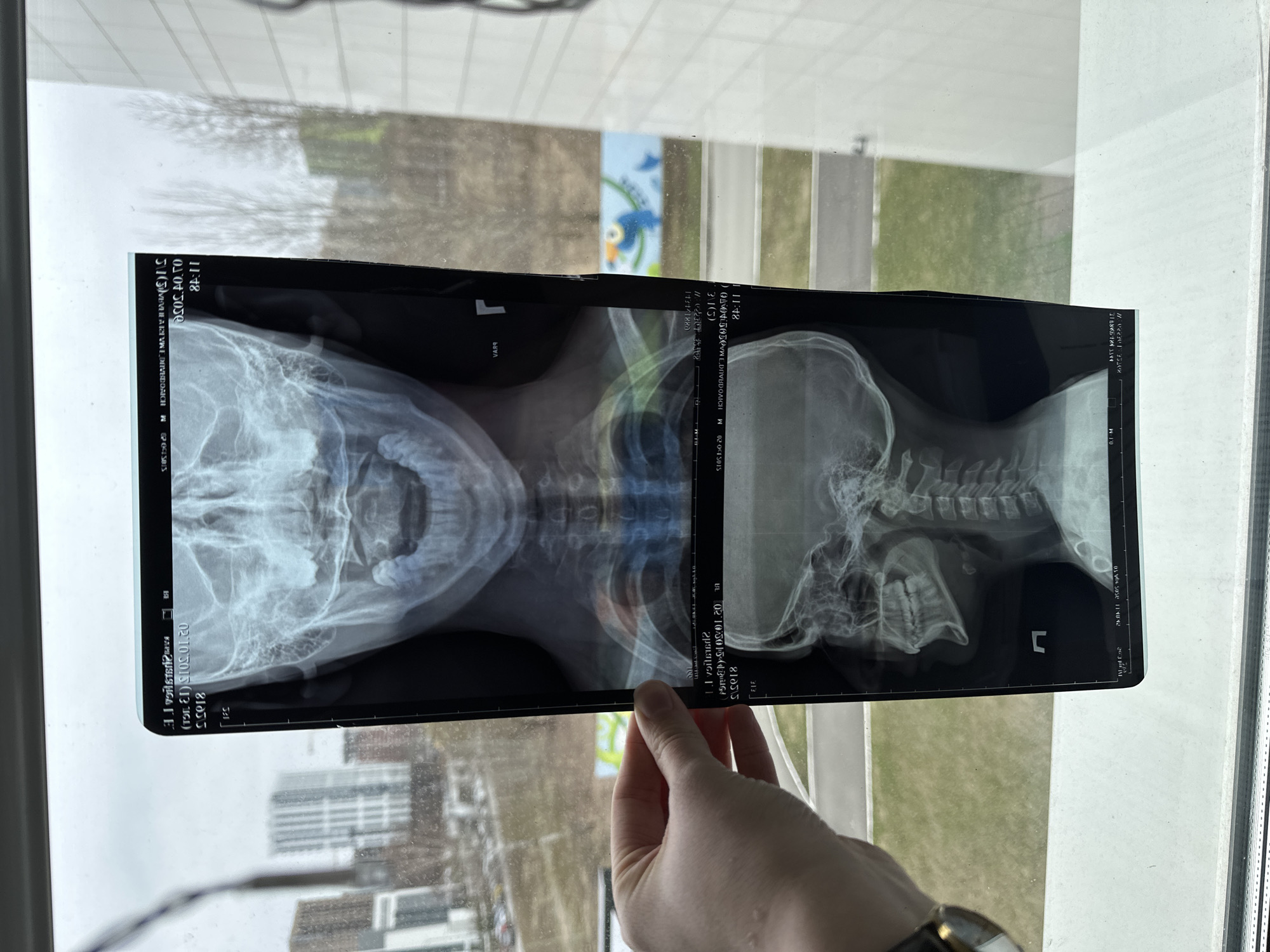 A person is holding up an x-ray film against a window. The film shows two views of a skull and cervical spine. The location is Kazan, Russia. The outside view shows a street, buildings, and trees. The person's hand and wrist are visible, including a watch. Some text is on the x-ray film.