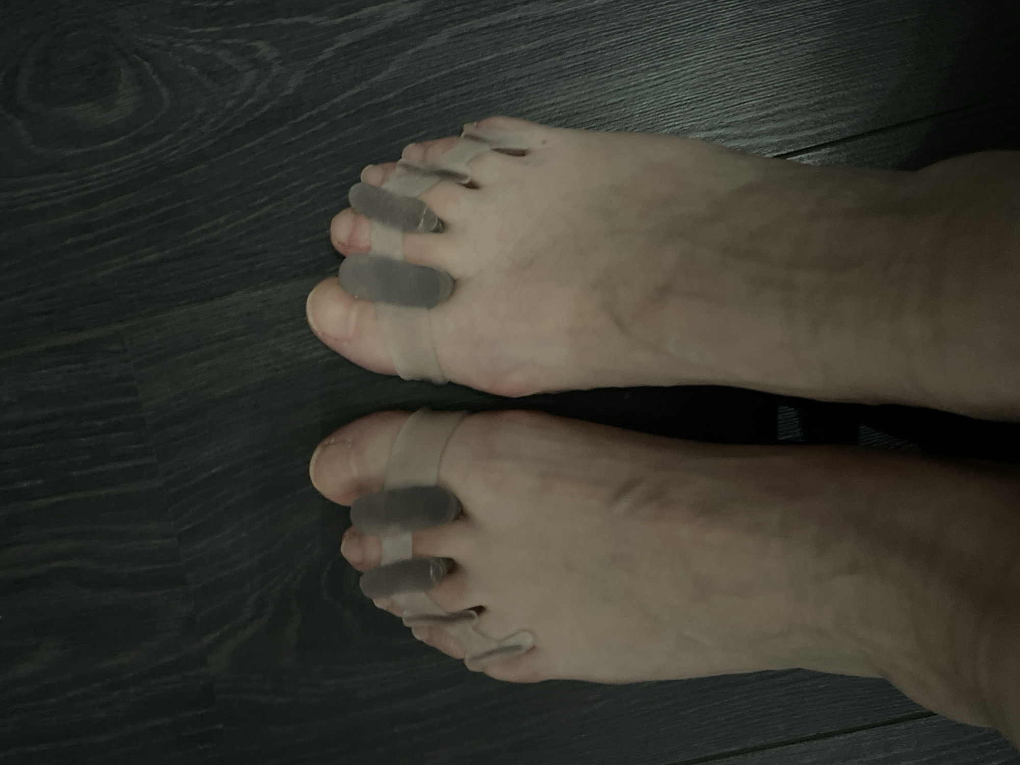Two feet are displayed against a dark wood-grain background. Each foot has a foot-alignment apparatus inserted between the toes. The location is unknown, and no connection to the city of Moskovskiy, Russia, can be inferred from the image.