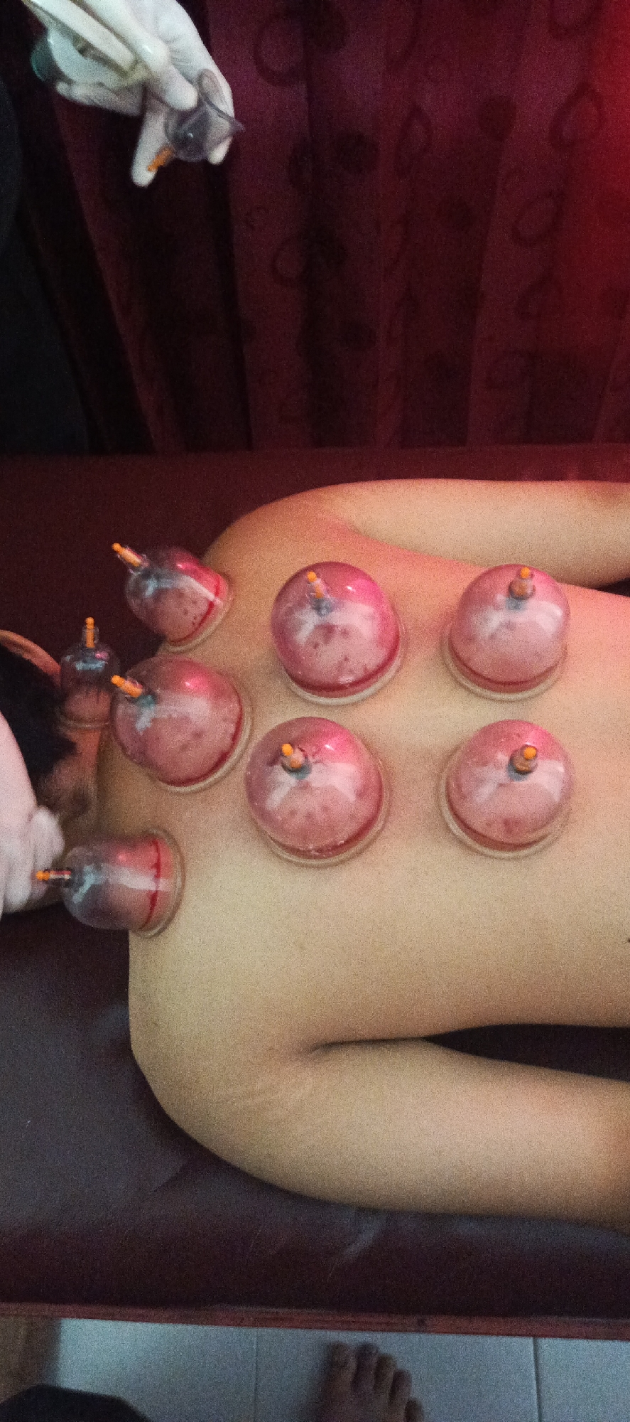 In Sukaresmi, Indonesia, a close-up shot captures a cupping therapy session on a person's back. Several translucent pink cups, each with an orange valve, are affixed to the skin. A gloved hand is visible, holding a suction device, likely in the process of applying or adjusting a cup. The background consists of dark red, textured curtains. The setting appears to be an indoor space, possibly a treatment room.