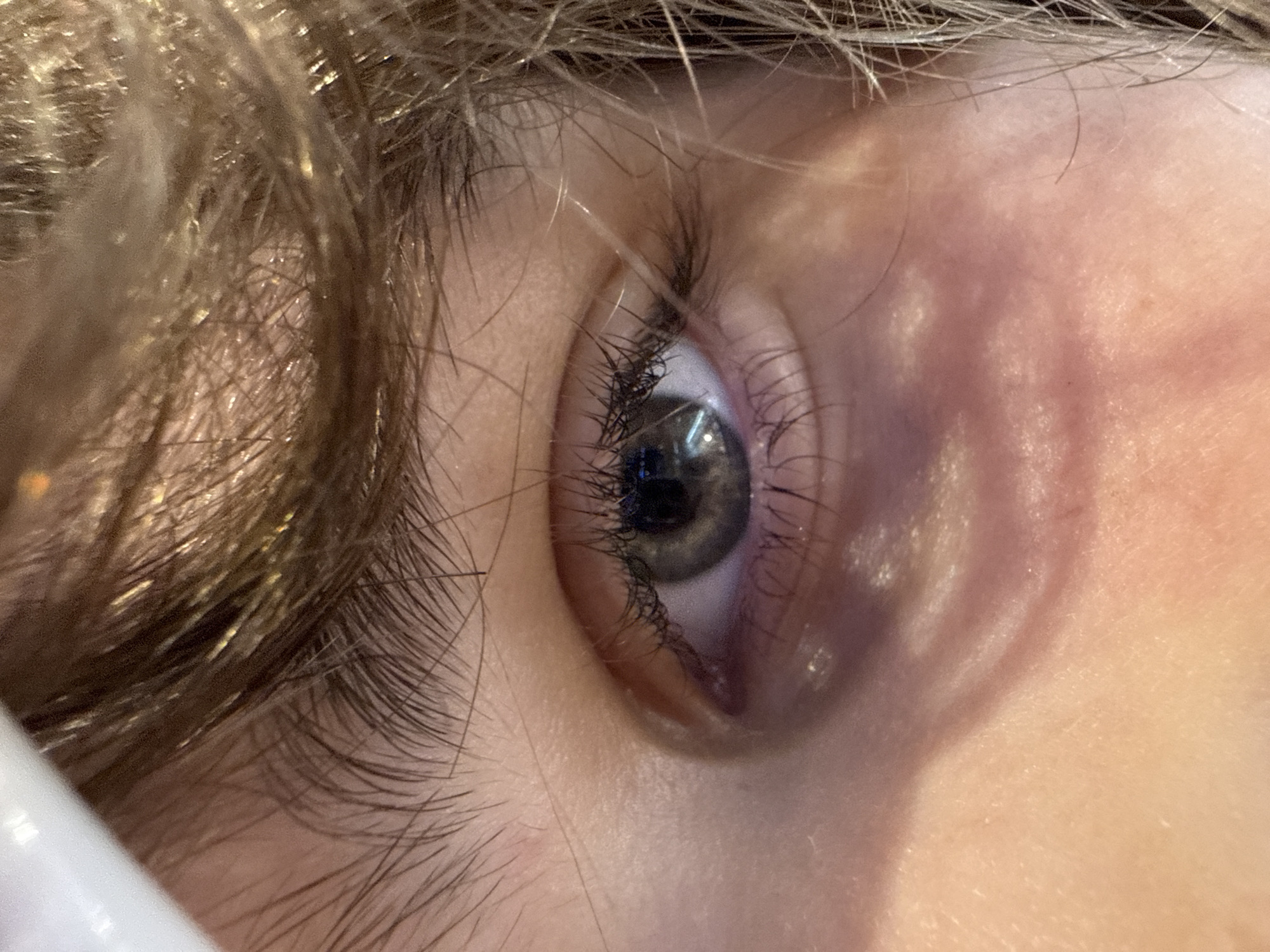 This is a close-up, eye-level shot of a person's left eye, with a focus on the area around the eye. The eye itself is open and appears to be a light green or grey color. The eyelashes are dark and prominent. The skin below the eye shows signs of redness and shadowing, suggesting possible fatigue or irritation. The individual's hair, which is a light brown color with some lighter highlights, is visible in the upper portion of the frame, framing the eye. The lighting appears to be artificial and somewhat harsh, casting shadows and highlighting textures on the skin. There are no discernible background elements that would indicate a specific location, and therefore, no information can be provided regarding the city of Odesa, Ukraine. The image is purely a close-up portrait of an eye and surrounding facial features.