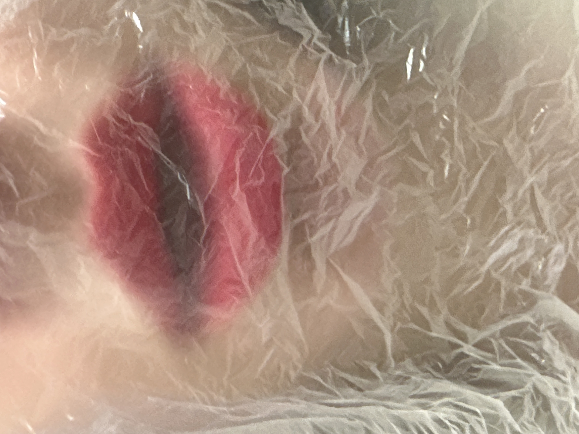 The image shows a reddish-purple bruise or wound covered by clear plastic wrap. The underlying skin surrounding the bruised area appears light-toned. Due to the lack of environmental context in the picture, determining the location in the city of Votkinsk, Russia is impossible. No people, interactions, or actions are discernible in the image beyond the presence of the covered injury.