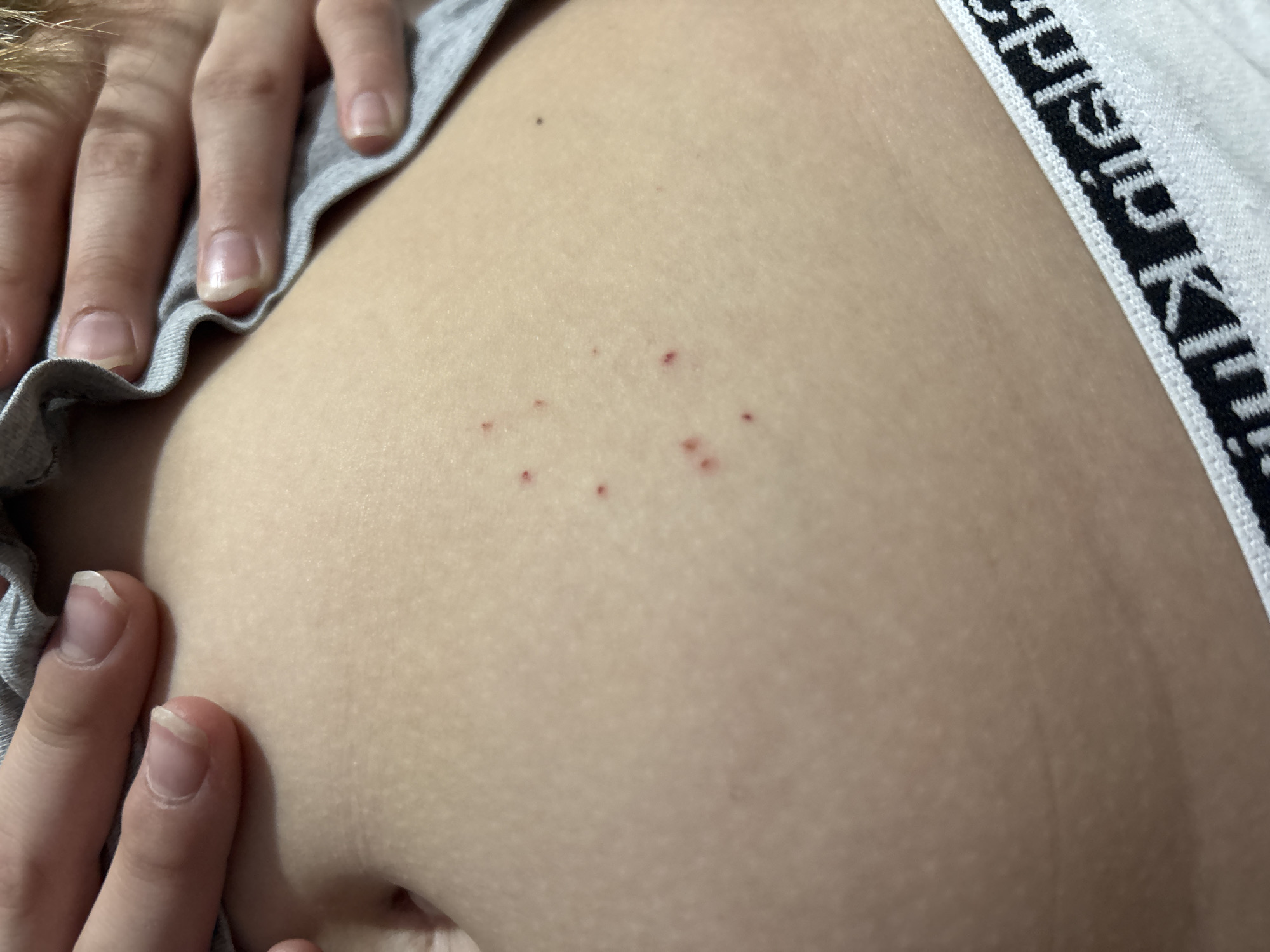 The image shows a close-up of a person's torso. The person is light-skinned and has a few red, pinpoint-sized spots or lesions on their abdomen. Their fingers are visible on the left side of the image, and the elastic band of undergarments, possibly Calvin Klein brand, is visible on the right. The background is blurred. There is no information in the image that indicates the location is Izhevsk, Russia.