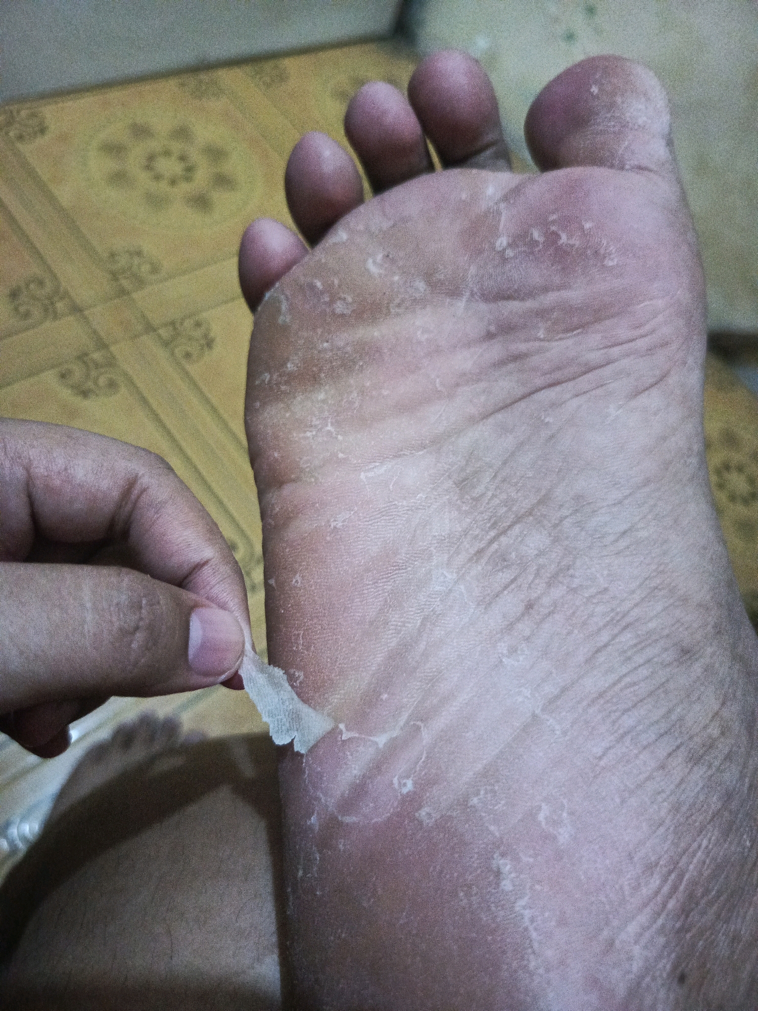 A close-up, overhead shot shows a person's foot with dry, peeling skin. A hand is gently pulling a piece of flaky skin from the sole of the foot. The foot appears to be on a patterned floor, possibly in a residential setting in Balaraja, Indonesia. The lighting is dim, and the image has a grainy texture.