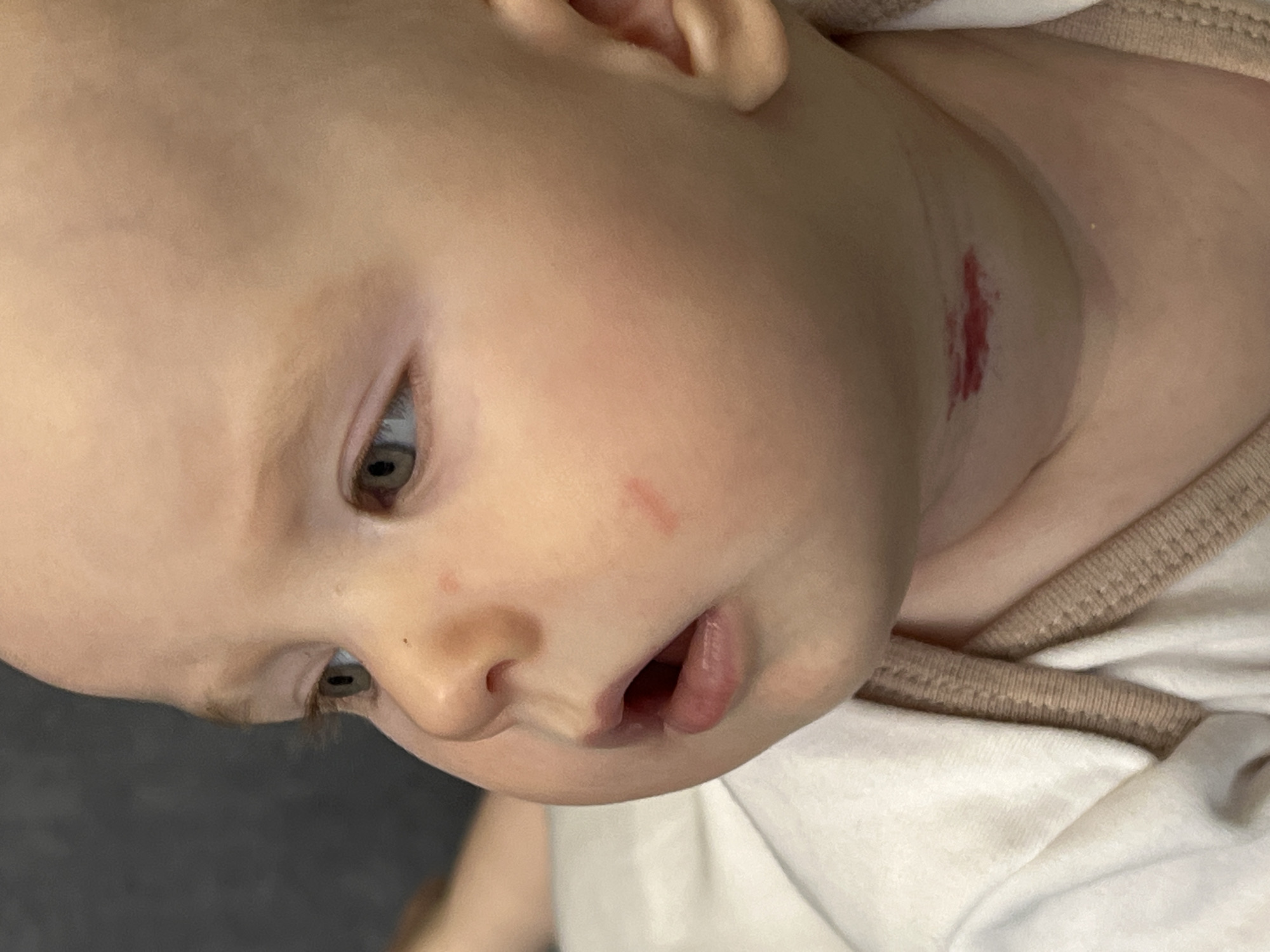 A close-up, slightly downward-angled shot shows a baby with fair skin and light blue eyes. The baby is wearing a white shirt with a tan-colored trim around the collar. There is a red mark on the baby's cheek and a larger, darker red mark on the baby's neck. The baby's mouth is slightly open. The background is a muted gray. There is no evidence to suggest the location is Chaikovsky, Russia.