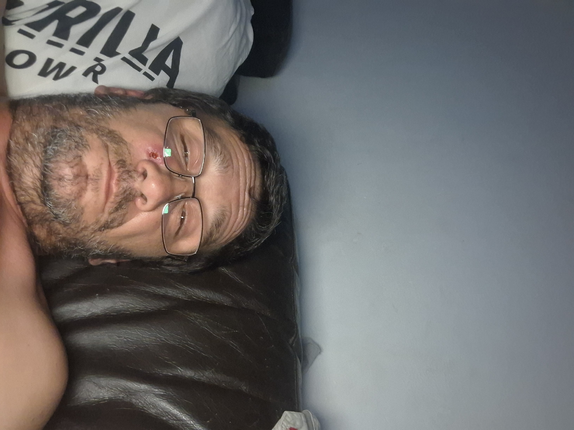 The image is a close-up selfie of a man lying down. He is wearing glasses and has a beard. There is a visible abrasion with some redness on his left cheekbone, near his eye. He appears to be indoors, possibly on a couch, with a dark, textured surface behind him and a light-colored, possibly fabric surface to his left with lettering on it. The overall lighting suggests an indoor environment. The location in Yerocham, Israel, is not discernible from the image itself.