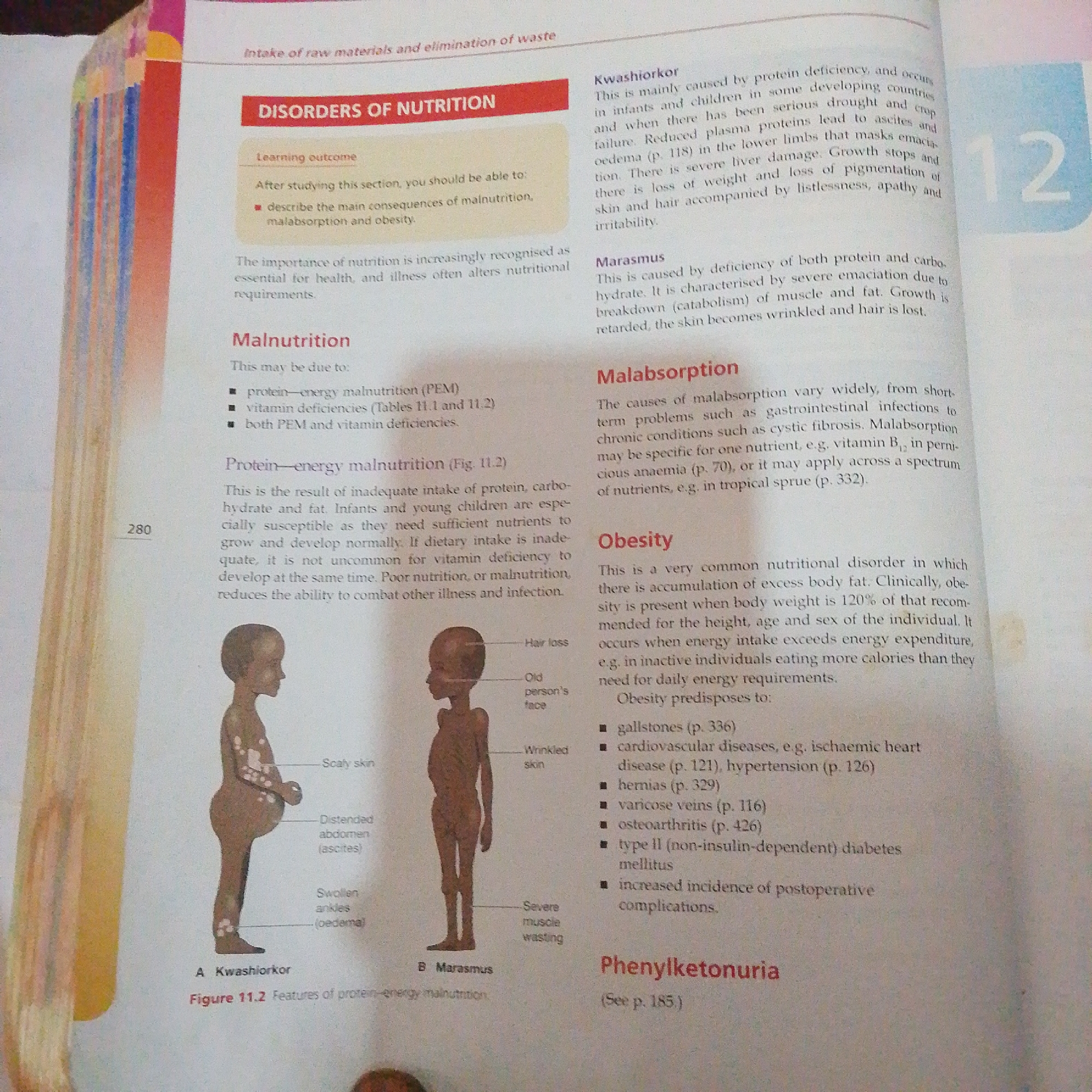 The image is a scanned page from a textbook. It discusses disorders of nutrition. The left side of the page has an illustration of two figures, labeled "A Kwashiorkor" and "B Marasmus," depicting the physical characteristics of these conditions. Text on the left side discusses malnutrition and protein-energy malnutrition. The right side of the page discusses Kwashiorkor, Marasmus, Malabsorption, and Obesity. It also introduces Phenylketonuria. There is no information within the image to suggest a location in Jalingo, Nigeria.
