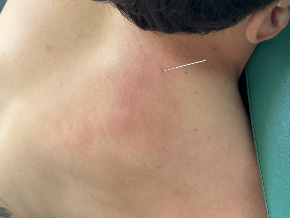An overhead, close-up forensic image depicts the upper back and right neck/shoulder area of a light-skinned individual in Las Crucitas, Mexico. The subject is lying face down on a teal or dark green surface, possibly an examination table. The upper left portion of the subject's back exhibits areas of reddish discoloration, consistent with erythema, and scattered small moles. A small portion of a dark tattoo is visible on the upper left shoulder. A slender, metallic needle is inserted into the skin on the right side of the neck, near the base of the skull/upper trapezius region. The needle is angled upwards and to the left, with its shaft extending outwards and terminating in a small, spherical end. Dark hair is visible along the right side of the subject's head, near the ear and hairline, at the bottom right of the frame.
