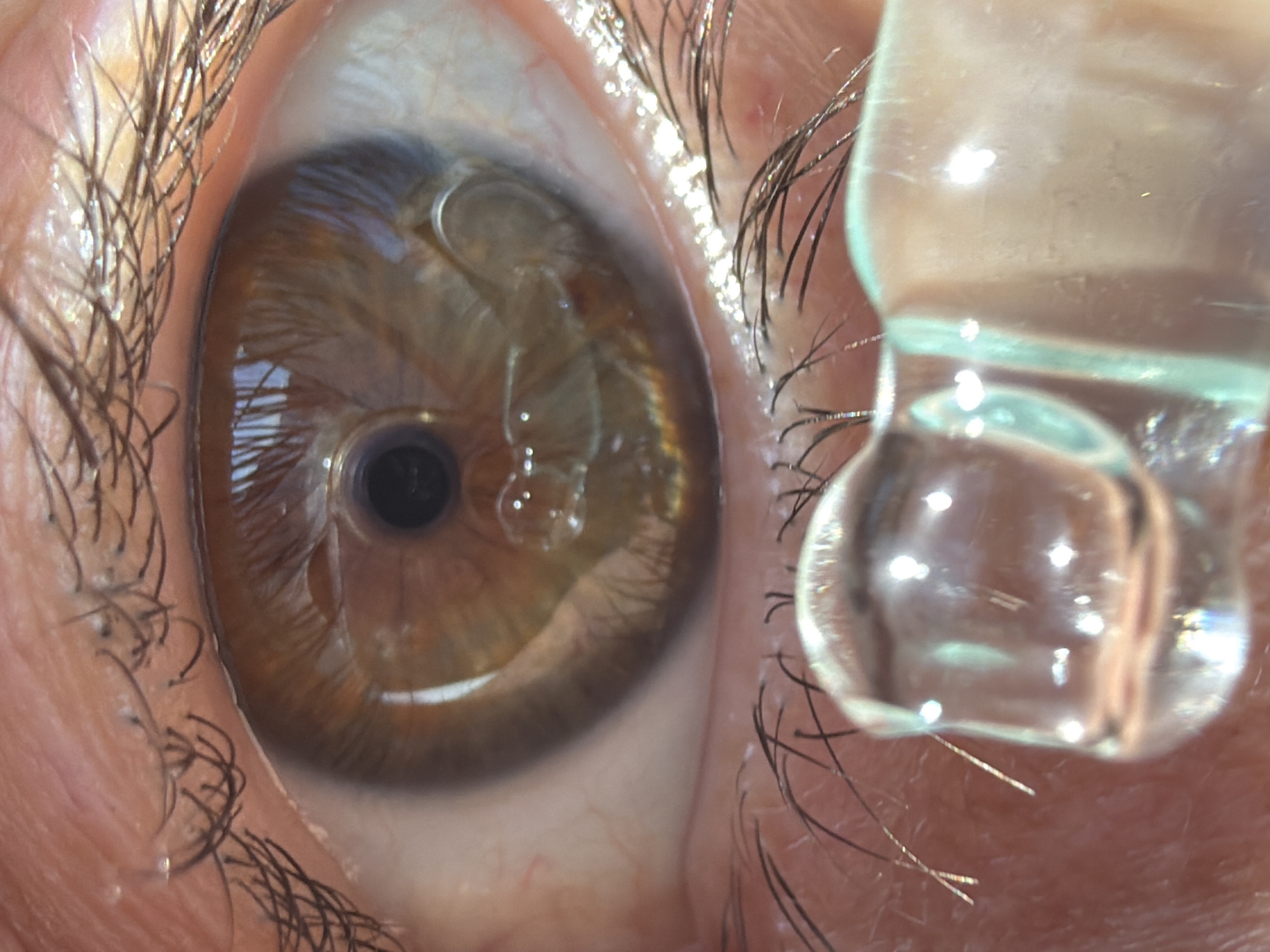 A close-up image shows a human eye, with a brown iris and a black pupil, being treated with an eye drop. The eye is surrounded by eyelashes and skin. A clear liquid drop, likely an eye drop solution, is visible near the outer corner of the eye, distorting the view behind it due to refraction. There is no evidence to suggest that this image was taken in Saint Petersburg, Russia.