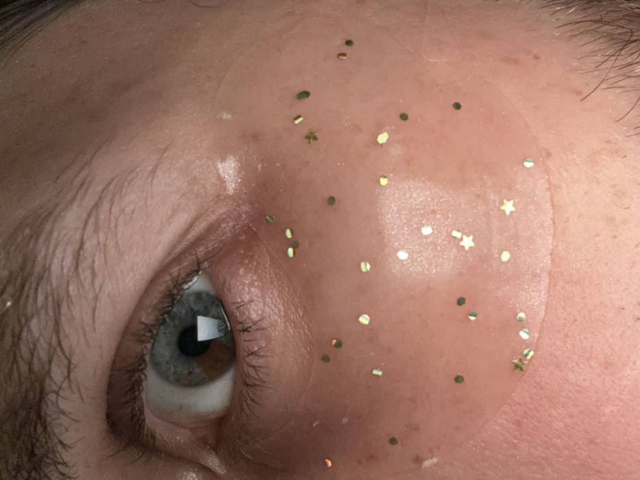 A close-up image shows an eye with heterochromia, having both blue and brown segments. A transparent, circular patch covers part of the forehead above the eye. The patch is adorned with numerous small, scattered gold and green glitter shapes including dots, stars, and clover-like figures. Some glitter also appears outside the patch area, on the brow bone and near the eyelashes. The skin is pale and slightly shiny.